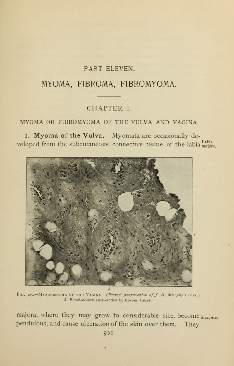 PART ELEVEN. MYOMA, FIBROMA, FIBROMYOMA. CHAPTER I. MYOMA OR FIBROMYOMA OF THE VULVA AND VAGINA. I. Myoma of the Vulva. Myomata are occasionally de- veloped from the subcutaneous connective tissue of the labia Labia majora. Fig. 305-— Myxofibroma of the Vagina. {Evans' preparation 0/ J. B. Murphy's case.) b. Blood-vessels surrounded by fibrous tisuse. majora, where they may grow to considerable size, become Sjze, etc. pendulous, and cause ulceration of the skin over them. They