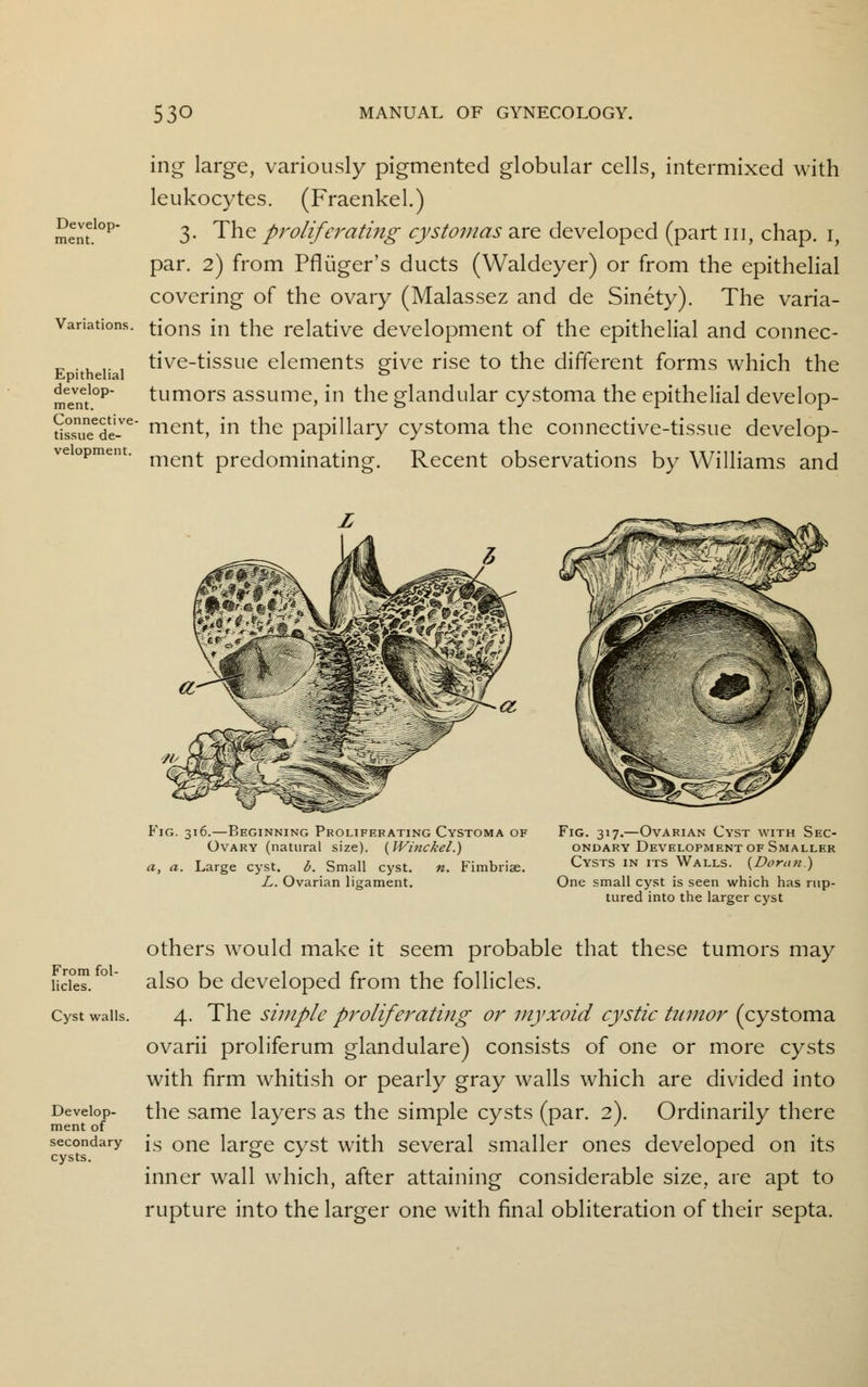 ing large, variously pigmented globular cells, intermixed with leukocytes. (Fraenkel.) 3. The proliferating cystomas are developed (part in, chap. 1, par. 2) from Pfliiger's ducts (Waldeyer) or from the epithelial covering of the ovary (Malassez and de Sinety). The varia- tions in the relative development of the epithelial and connec- tive-tissue elements give rise to the different forms which the tumors assume, in the glandular cystoma the epithelial develop- ussnuneede-ve* merit, in the papillary cystoma the connective-tissue develop- eopm< . menj. predominating. Recent observations by Williams and Develop- ment. Variations. Epithelial develop- ment. Fig. 316.—Beginning Proliferating Cystoma of Ovary (natural size). {Winckel.) a, a. Large cyst. b. Small cyst. n. Fimbriae. L. Ovarian ligament. Fig. 317.—Ovarian Cyst with Sec- ondary Development of Smaller Cysts in its Walls. {Domn.) One small cyst is seen which has rup- tured into the larger cyst others would make it seem probable that these tumors may also be developed from the follicles. 4. The simple proliferating or myxoid cystic tumor (cystoma ovarii proliferum glandulare) consists of one or more cysts with firm whitish or pearly gray walls which are divided into the same layers as the simple cysts (par. 2). Ordinarily there secondary js one large cyst with several smaller ones developed on its inner wall which, after attaining considerable size, are apt to rupture into the larger one with final obliteration of their septa. From fol- licles. Cyst walls. Develop ment of