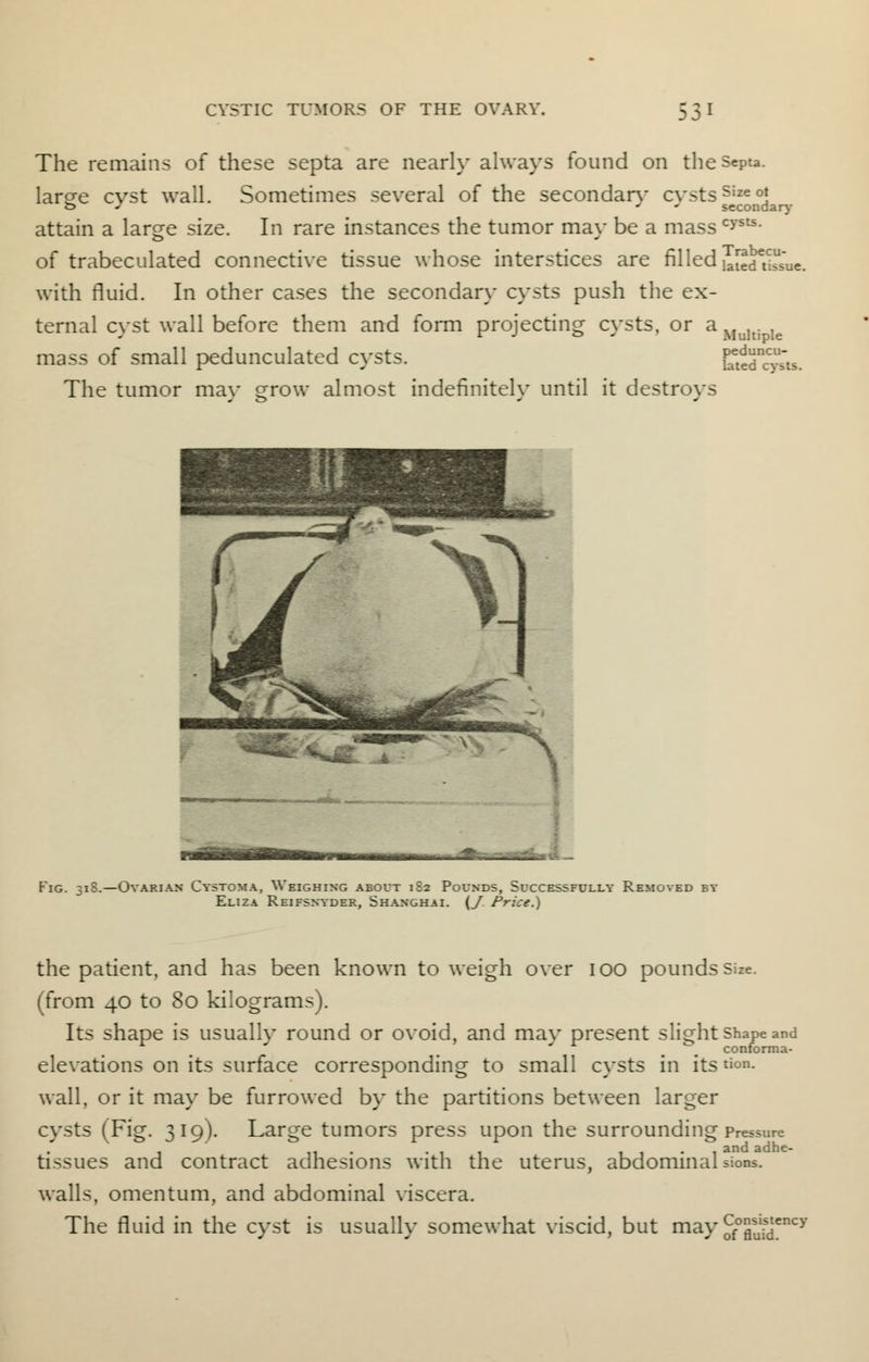 The remains of these septa are nearly always found on theSepta. largre cvst wall. Sometimes several of the secondarv cvstsSizeoJ o / * secondary- attain a large size. In rare instances the tumor may be a masscysts- of trabeculated connective tissue whose interstices are filled EStiSue. with fluid. In other cases the secondary cysts push the ex- ternal cyst wall before them and form projecting cysts, or a Mu]tj k mass of small pedunculated cysts. ESS!*. The tumor may grow almost indefinitely until it destroys Fig. 31S.—Ovarian Cystoma, Weighing about 1S2 Pounds, Successfully Removed by Eliza Reifsnyder, Shanghai. (J Price.) the patient, and has been known to weigh over ioo pounds size, (from 40 to 80 kilograms). Its shape is usually round or ovoid, and mav present slight shape and ' * m conforma- elevations on its surface corresponding to small cysts in its <>n- wall, or it may be furrowed by the partitions between larger cysts (Fig. 319). Large tumors press upon the surrounding Pressure tissues and contract adhesions with the uterus, abdominal sions. walls, omentum, and abdominal viscera. The fluid in the cyst is usually somewhat viscid, but may S'S6^*