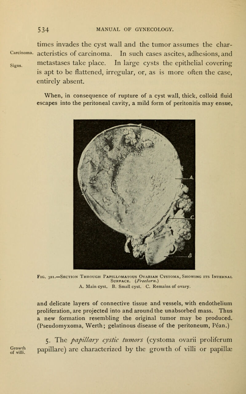 times invades the cyst wall and the tumor assumes the char- Carcinoma. acteristics of carcinoma. In such cases ascites, adhesions, and signs. metastases take place. In large cysts the epithelial covering is apt to be flattened, irregular, or, as is more often the case, entirely absent. When, in consequence of rupture of a cyst wall, thick, colloid fluid escapes into the peritoneal cavity, a mild form of peritonitis may ensue, Fig. 321.—Section Through Papillomatous Ovarian Cystoma, Showing its Internal Surface. {Freeborn.) A. Main cyst. B. Small cyst. C. Remains of ovary. Growth of villi. and delicate layers of connective tissue and vessels, with endothelium proliferation, are projected into and around the unabsorbed mass. Thus a new formation resembling the original tumor may be produced. (Pseudomyxoma, Werth; gelatinous disease of the peritoneum, Pean.) 5. The papillary cystic tumors (cystoma ovarii proliferum papillare) are characterized by the growth of villi or papillae