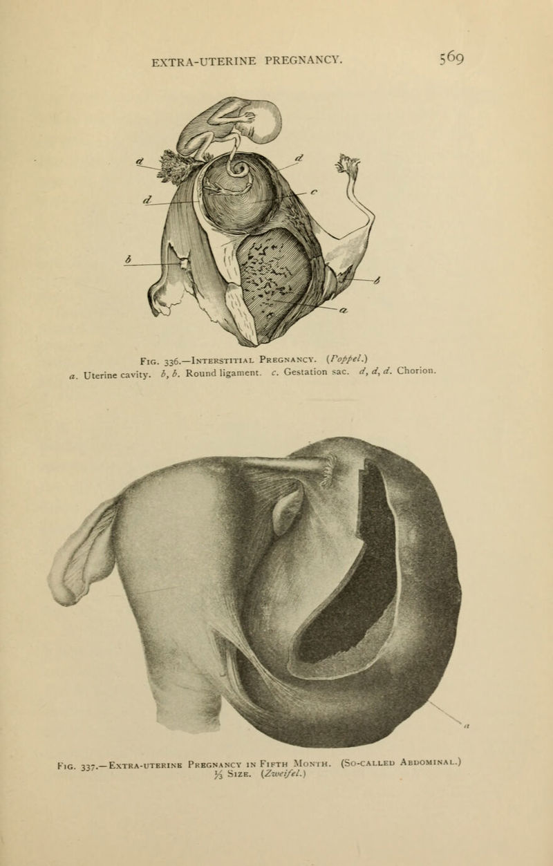 Fig. 336.—Interstitial Pregnancy. {Poppel.) a. Uterine cavity. b,b. Round ligament, c. Gestation sac. d, d, d. Chorion. Fig. 337— Extra-uterine Pregnancy in Fifth Month. (So-called Abdominal.) 13 Size. {Ziveifel.)