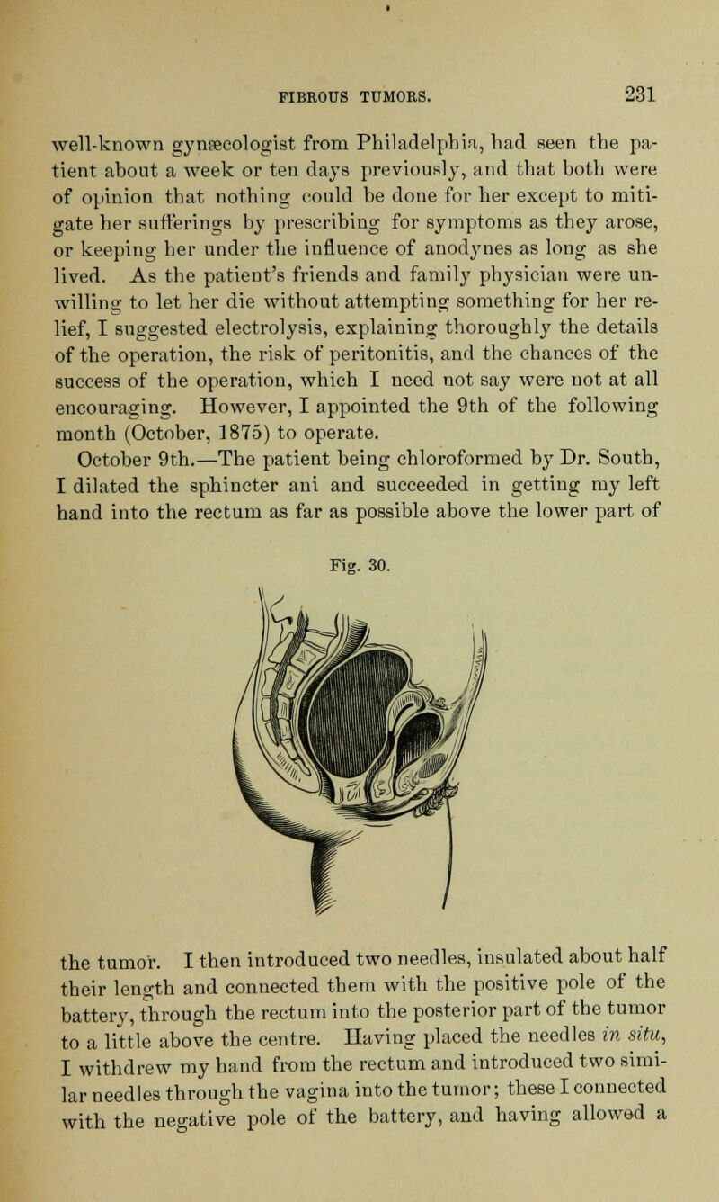 well-known gynaecologist from Philadelphia, had seen the pa- tient about a week or ten days previously, and that both were of opinion that nothing could be done for her except to miti- gate her sufferings by prescribing for symptoms as they arose, or keeping her under the influence of anodynes as long as she lived. As the patient's friends and family physician were un- willing to let her die without attempting something for her re- lief, I suggested electrolysis, explaining thoroughly the details of the operation, the risk of peritonitis, and the chances of the success of the operation, which I need not say were not at all encouraging. However, I appointed the 9th of the following month (October, 1875) to operate. October 9th.—The patient being chloroformed by Dr. South, I dilated the sphincter ani and succeeded in getting my left hand into the rectum as far as possible above the lower part of Fig. 30. the tumor. I then introduced two needles, insulated about half their length and connected them with the positive pole of the battery, through the rectum into the posterior part of the tumor to a little above the centre. Having placed the needles in situ, I withdrew my hand from the rectum and introduced two simi- lar needles through the vagina into the tumor; these I connected with the negative pole of the battery, and having allowed a