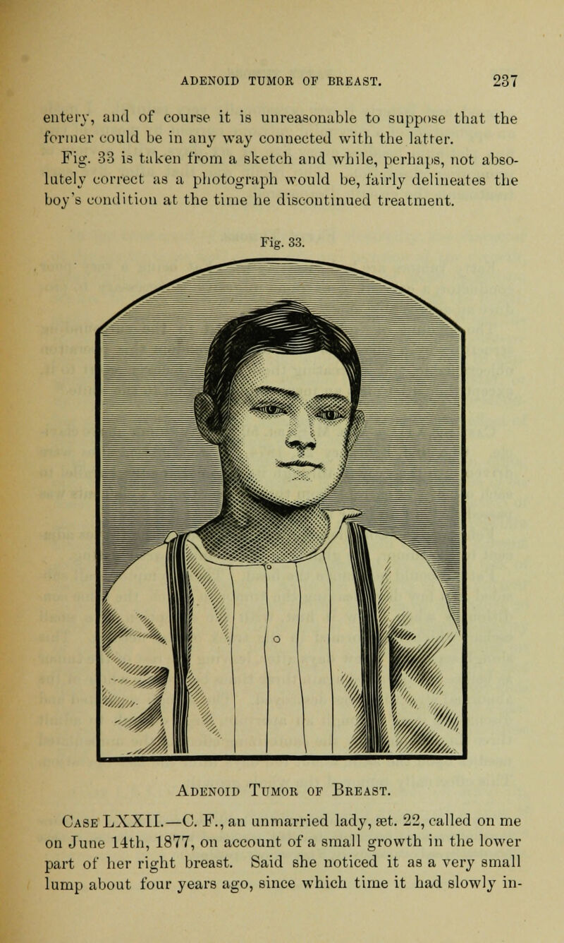 entery, and of course it is unreasonable to suppose that the former could be in any way connected with the latter. Fig. 33 is taken from a sketch and while, perhaps, not abso- lutely correct as a photograph would be, fairly delineates the boy's condition at the time he discontinued treatment. Fig. 33. Adenoid Tumor of Breast. Case LXXII.—C. F., an unmarried lady, set. 22, called on me on June 14th, 1877, on account of a small growth in the lower part of her right breast. Said she noticed it as a very small lump about four years ago, since which time it had slowly in-