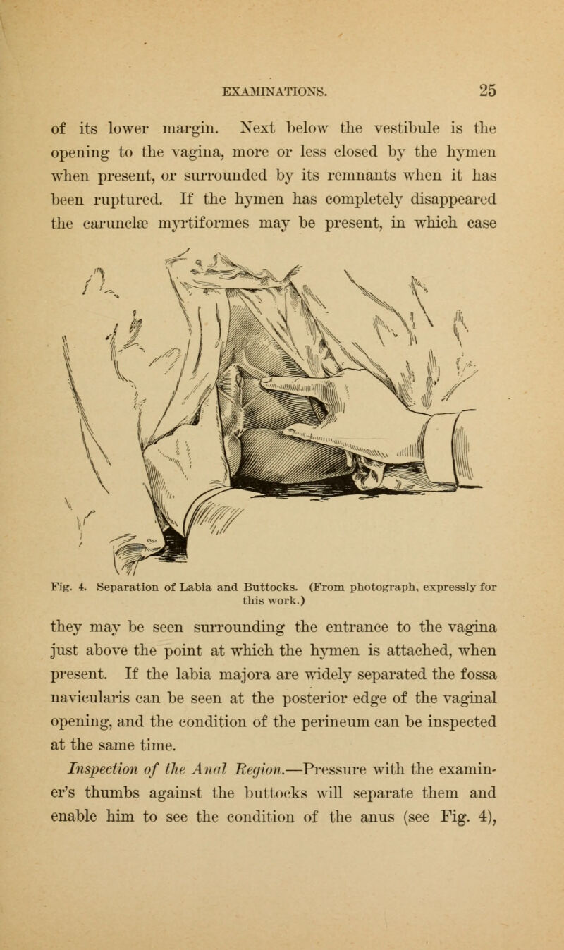 of its lower margin. Next below the vestibule is the opening to the vagina, more or less closed by the hymen when present, or surrounded by its remnants when it has been ruptured. If the hymen has completely disappeared the caruncla? myrtifornies may be present, in which case Fig. 4. Separation of Labia and Buttocks. (From photograph, expressly for this work.) they may be seen surrounding the entrance to the vagina just above the point at which the hymen is attached, when present. If the labia majora are widely separated the fossa navicularis can be seen at the posterior edge of the vaginal opening, and the condition of the perineum can be inspected at the same time. Inspection of the Anal Region.—Pressure with the examin- er's thumbs against the buttocks will separate them and enable him to see the condition of the anus (see Fig. 4),