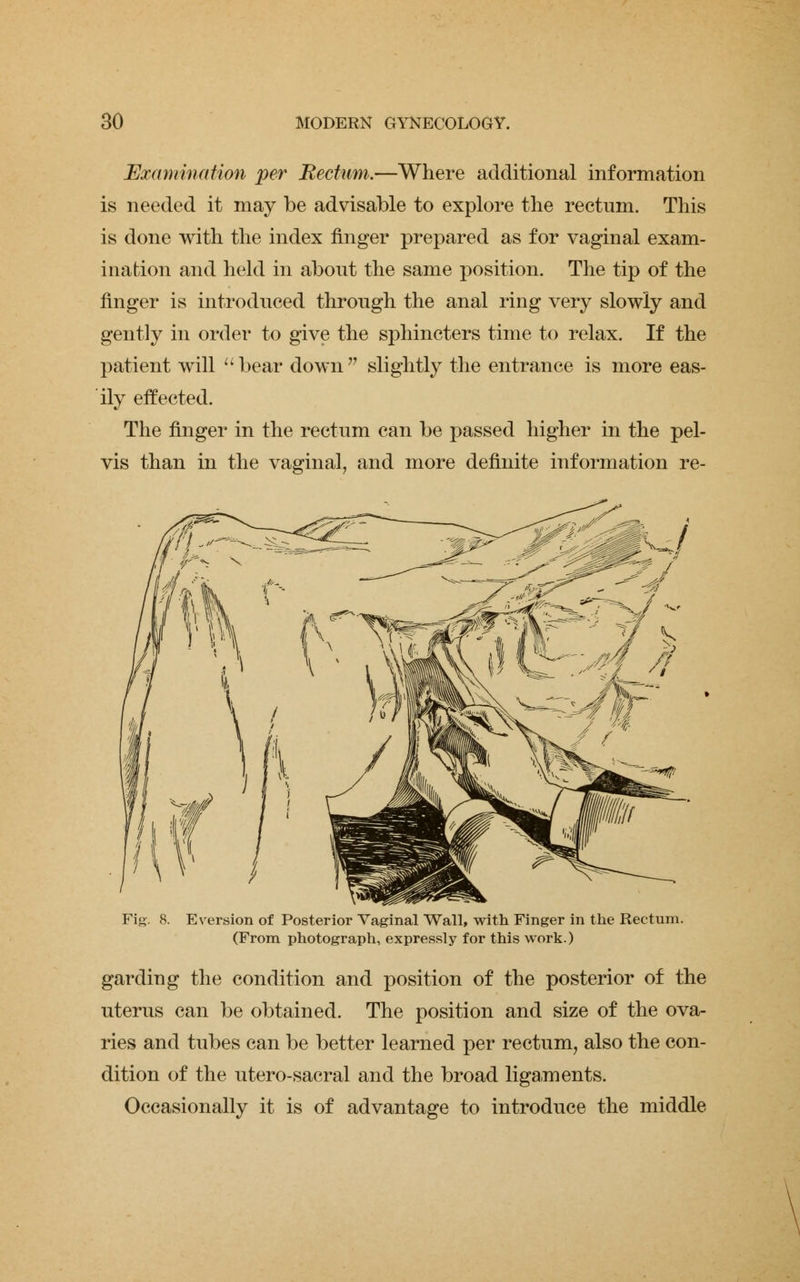 Examination per Rectum.—Where additional information is needed it may be advisable to explore the rectum. This is done with the index finger prepared as for vaginal exam- ination and held in about the same position. The tip of the finger is introduced through the anal ring very slowly and gently in order to give the sphincters time to relax. If the patient will bear down slightly the entrance is more eas- ily effected. The finger in the rectum can be passed higher in the pel- vis than in the vaginal, and more definite information re- Fig. 8. E version of Posterior Vaginal Wall, with Finger in the Rectum. (From photograph, expressly for this work.) garding the condition and position of the posterior of the uterus can be obtained. The position and size of the ova- ries and tubes can be better learned per rectum, also the con- dition of the utero-sacral and the broad ligaments. Occasionally it is of advantage to introduce the middle