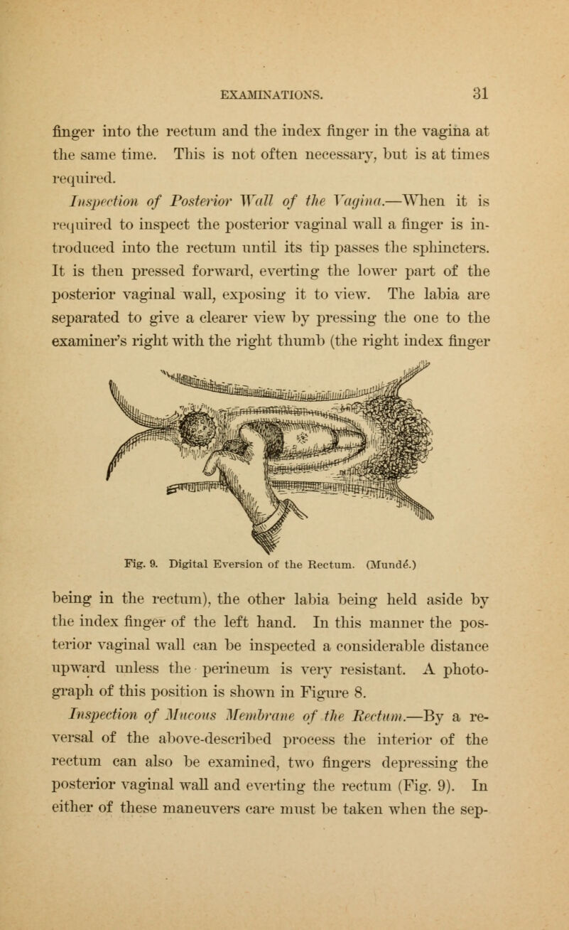finger into the rectum and the index finger in the vagina at the same time. This is not often necessary, but is at times required. Inspection of Posterior Wall of the Vagina.—When it is required to inspect the posterior vaginal wall a finger is in- troduced into the rectum until its tip passes the sphincters. It is then pressed forward, everting the lower part of the posterior vaginal wall, exposing it to view. The labia are separated to give a clearer view by pressing the one to the examiner's right with the right thumb (the right index finger Fig. 9. Digital Eversion of the Rectum. (Munde.) being in the rectum), the other labia being held aside by the index finger of the left hand. In this manner the pos- terior vaginal wall can be inspected a considerable distance upward unless the perineum is very resistant, A photo- graph of this position is shown in Figure 8. Inspection of Mucous Membrane of the Rectum.—By a re- versal of the above-described process the interior of the rectum can also be examined, two fingers depressing the posterior vaginal wall and everting the rectum (Fig. 9). In either of these maneuvers care must be taken when the sep-