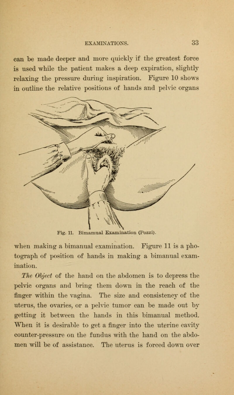 can be made deeper and more quickly if the greatest force is used while the patient makes a deep expiration, slightly relaxing the pressure during inspiration. Figure 10 shows in outline the relative positions of hands and pelvic organs Fig. 11. Bimamual Examination (Pozzi). when making a bimanual examination. Figure 11 is a pho- tograph of position of hands in making a bimanual exam- ination. The Object of the hand on the abdomen is to depress the pelvic organs and bring them down in the reach of the finger within the vagina. The size and consistency of the uterus, the ovaries, or a pelvic tumor can be made out by getting it between the hands in this bimanual method. When it is desirable to get a finger into the uterine cavity counter-pressure on the fundus with the hand on the abdo- men will be of assistance. The uterus is forced down over