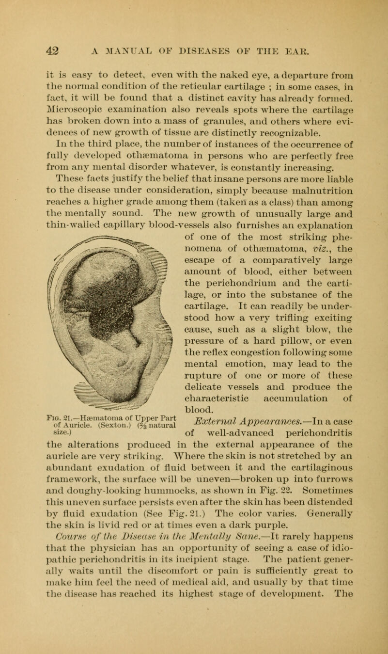 it is easy to detect, even Avith the naked eye, a departure from the normal condition of the reticular cartilage ; in some cases, in fact, it will be found that a distinct cavity has already formed. Microscopic examination also reveals spots where the cartilage has broken down into a mass of granules, and others where evi- dences of new growth of tissue are distinctly recognizable. In the third place, the number of instances of the occurrence of fully developed othematoma in persons who are perfectly free from any mental disorder whatever, is constantly increasing. These facts justify the belief that insane persons are more liable to the disease under consideration, simply because malnutrition reaches a higher grade among them (taken as a class) than among the mentally sound. The new growth of unusually large and thin-walled capillary blood-vessels also furnishes an explanation of one of the most striking phe- nomena of othematoma, viz., the escape of a comparatively large amount of blood, either between the perichondrium and the carti- lage, or into the substance of the cartilage. It can readily be under- stood how a very trifling exciting cause, such as a slight blow, the pressure of a hard pillow, or even the reflex congestion following some mental emotion, may lead to the rupture of one or more of these delicate vessels and produce the characteristic accumulation of blood. External Appearances.—In a case of well-advanced perichondritis the alterations produced in the external appearance of the auricle are very striking. Where the skin is not stretched by an abundant exudation of fluid between it and the cartilaginous framework, the surface will be uneven—broken up into furrows and doughy-looking hummocks, as shown in Fig. 22. Sometimes this uneven surface persists even after the skin has been distended by fluid exudation (See Fig. 21.) The color varies. Generally the skin is livid red or at times even a dark purple. Course <>f the Disease in th> Mentally Sane.—It rarely happens ih.ii the physician has an opportunity of seeing a case of idio- pathic perichondritis in its incipient stage. The patient gener- ally waits until the discomfort or pain is sufficiently great to make him feel the need of medical aid, and usually by that time the disease has reached its highest stage of development. The Fig. 21.—Haematoma of Upper Part of Auricle. (Sexton.) (^natural size.)