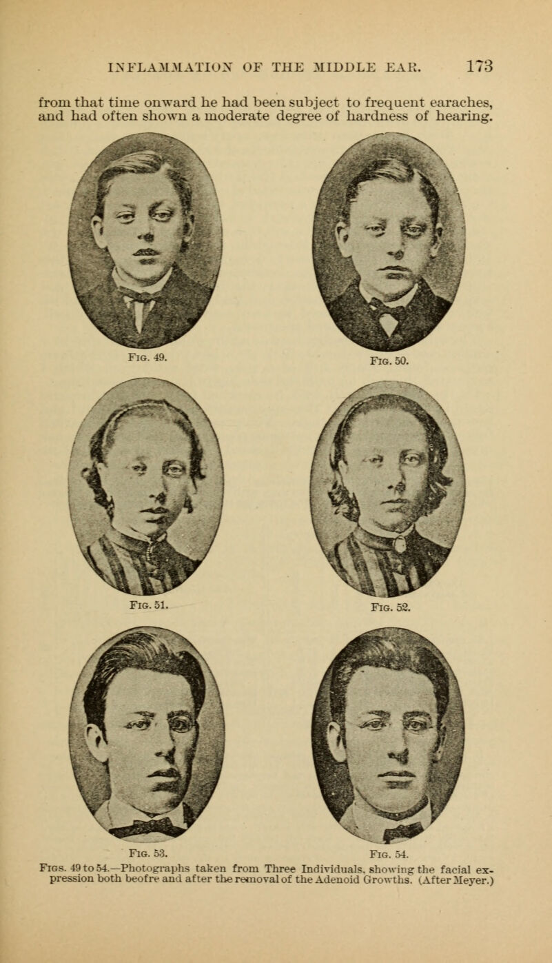 from That time onward he had been subject to frequent earaches, and had often shown a moderate degree of hardness of hearing. /* Fig. 49. Fig. 50. Fig. 51. Fig. 52. Fig. 53. Fig. 54. Figs. 49 to 54.—Photographs taken from Three Individuals, showing the facial ex- pression both beofre and after the removal of the Adenoid Growths. (After Meyer.)