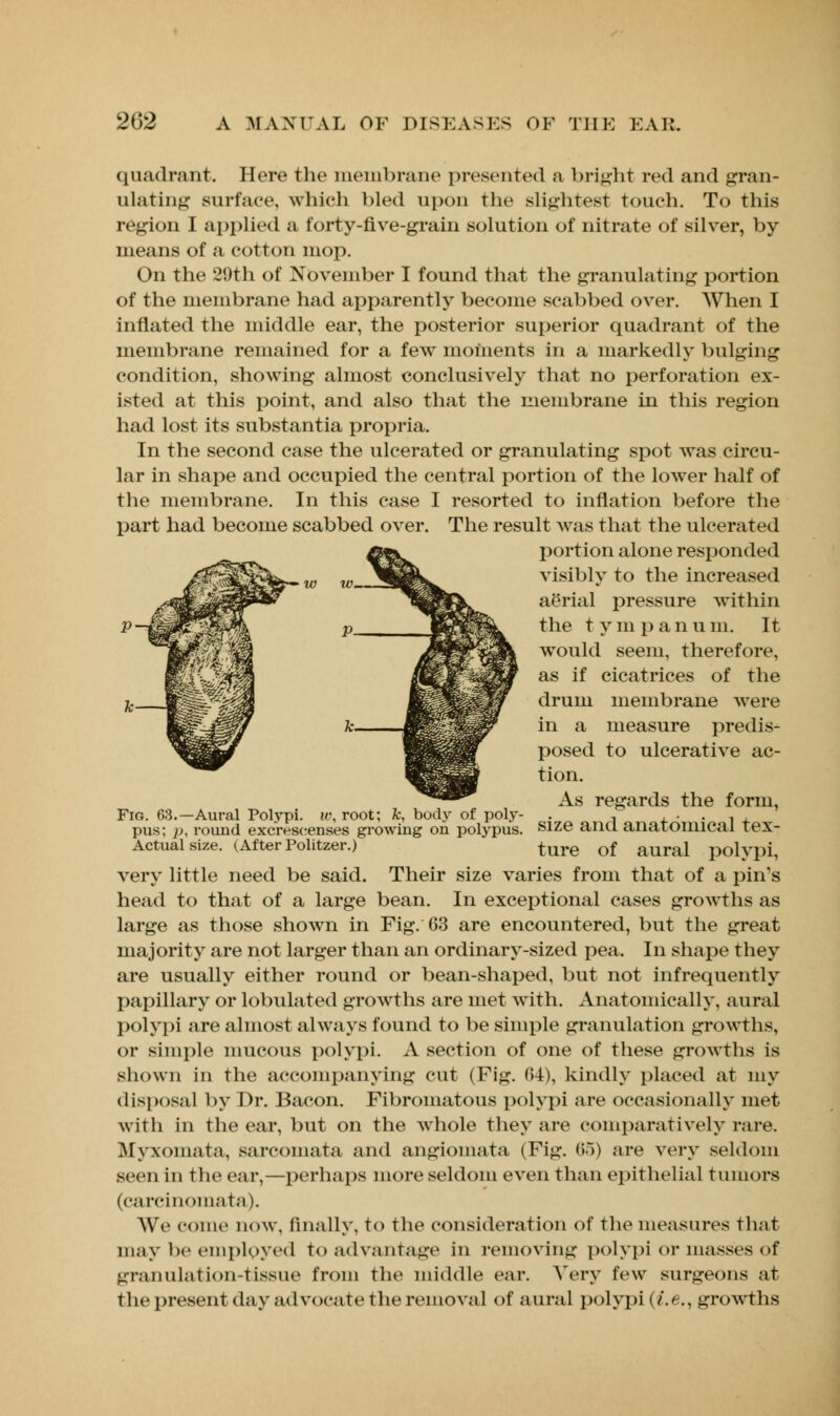quadrant. Here the membrane presented a bright red and gran- ulating surface, which bled upon the slightest touch. To this region I applied a forty-five-grain solution of nitrate of silver, by means of a cotton mop. On the 29th of November I found that the granulating portion of the membrane had apparently become scabbed over. When I inflated the middle ear, the posterior superior quadrant of the membrane remained for a few moments in a markedly bulging condition, showing almost conclusively that no perforation ex- isted at this point, and also that the membrane in this region had lost its substantia propria. In the second case the ulcerated or granulating spot was circu- lar in shape and occupied the central portion of the lower half of the membrane. In this case I resorted to inflation before the part had become scabbed over. The result was that the ulcerated portion alone responded visibly to the increased aerial pressure within the t y m panu m. It would seem, therefore, as if cicatrices of the drum membrane were in a measure predis- posed to ulcerative ac- tion. As regards the form, Fig. 63.—Aural Polypi, w, root; k, body of polj*- . , , . . , , pus; ]>, round excrescenses growing on polypus. Size and. anatomical tex- Actualsi/.e. (AfterPolitzer.) ture of aural polypi, very little need be said. Their size varies from that of a pin's head to that of a large bean. In exceptional cases growths as large as those shown in Fig. 63 are encountered, but the great majority are not larger than an ordinary-sized pea. In shape they are usually either round or bean-shaped, but not infrequently papillary or lobulated growths are met with. Anatomically, aural polypi are almost always found to be simple granulation growths, or simple mucous polypi. A section of one of these growths is shown in the accompanying cut (Fig. (54), kindly placed at my disposal by Dr. Bacon. Fibromatous polypi are occasionally met with in the ear, but on the Avhole they are comparatively rare. Myxomata, sarcomata and angiomata (Fig. 65) are very seldom seen in the ear,—perhaps more seldom even than epithelial tumors (carcinomata). We come now. finally, to the consideration of the measures that may be employed to advantage in removing polypi or masses of granulation-tissue from the middle ear. Very few surgeons at the present day advocate the removal of aural polypi (i.e., growths