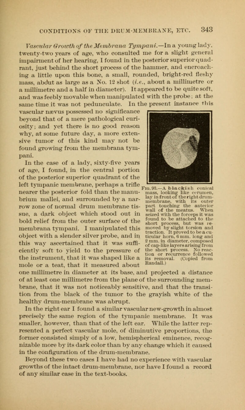 Vascular Growth of the Membrana Tympani.—ln a young lady. twenty-two years of age. who consulted me for a slight general impairment of her hearing, I found in the posterior superior quad- rant, just behind the short process of the hammer, and encroach- ing a little upon this bone, a small, rounded, bright-red fleshy mass, abdut as large as a Xo. 12 shot {i.e., about a millimetre or a millimetre and a half in diameter). It appeared to be quite soft, and was feebly movable when manipulated with the probe; at the same time it was not pedunculate. In the present instance tin's vascular naevus possessed no significance beyond that of a mere pathological curi- osity; and yet there is no good reason why, at some future day. a more exten- sive tumor of this kind may not be found growing from the membrana tym- pani. In the case of a lady, sixty-five years of age, I found, in the central portion of the posterior superior quadrant of the left tvmpanic membrane, perhaps a trifle „ * m , _ , ! Fig.93.—A blackish conical nearer the posterior fold than the manu- mass, looking like cerumen, brium mallei, and surrounded by a nar- row zone of normal drum membrane tis- sue, a dark object which stood out in bold relief from the outer surface of the membrana tyinpani. I manipulated this object with a slender silver probe, and in this way ascertained that it was suffi- ciently soft to yield to the pressure of the instrument, that it was shaped like a mole or a teat, that it measured about one millimetre in diameter at its base, and projected a distance of at least one millimetre from the plane of the surrounding mem- brane, that it was not noticeably sensitive, and that the transi- tion from the black of the tumor to the grayish white of the healthy drum-membrane was abrupt. In the right ear I found a similar vascular new-growth in almost precisely the same region of the tympanic membrane. It was smaller, however, than that of the left ear. While the latter rep- resented a perfect vascular mole, of diminutive proportions, the former consisted simply of a low, hemispherical eminence, recog- nizable more by its dark color than by any change which it caused in the configuration of the drum-membrane. Beyond these two cases I have had no experience with vascular growths of the intact drum-membrane, nor have I found a record of any similar case in the text-books. lay in front of the right drum- membrane, with its outer part touching: the anteiior wall of the meatus. When seized with the forceps it was found to be attached to the short process, but was re- moved by slight torsion and traction. It proved to be a cu tieular horn. 6 mm. long and 2 mm. in diameter, composed of cap-like layers arising from the short process. No reac- tion or recurrence followed its removal. (Copied from Randall.)
