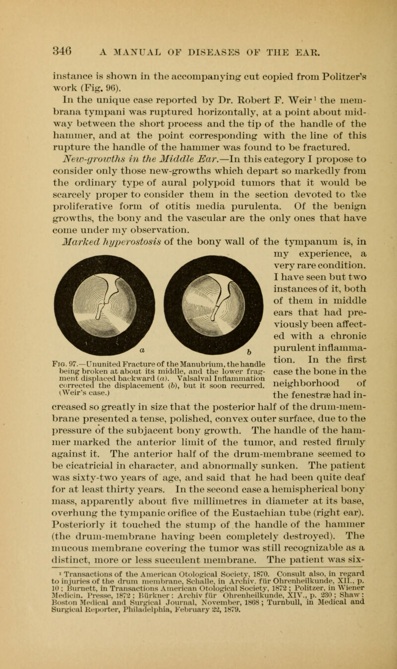 instance is shown in the accompanying cut copied from Politzer's work (Pig. 96). In the unique case reported by Dr. Robert F. Weir1 the mem- brana tympani was ruptured horizontally, at a point about mid- way between the short process and the tip of the handle of the hammer, and at the point corresponding with the line of this rupture the handle of the hammer was found to be fractured. New-growths in the Middle Ear.—In this category I propose to consider only those new-growths which depart so markedly from the ordinary type of aural polypoid tumors that it would be scarcely proper to consider them in the section devoted to the proliferative form of otitis media purulenta. Of the benign growths, the bony and the vascular are the only ones that have come under my observation. Marked hyperostosis of the bony wall of the tympanum is, in my experience, a very rare condition. I have seen but two instances of it, both of them in middle ears that had pre- viously been affect- ed with a chronic purulent inflamma- tion. In the first case the bone in the neighborhood of the fenestras had in- creased so greatly in size that the posterior half of the drum-mem- brane presented a tense, polished, convex outer surface, due to the pressure of the subjacent bony growth. The handle of the ham- mer marked the anterior limit of the tumor, and rested firmly against it. The anterior half of the drum-membrane seemed to be cicatricial in character, and abnormally sunken. The patient was sixty-two years of age, and said that he had been quite deaf for at least thirty years. In the second case a hemispherical bony mass, apparently about five millimetres in diameter at its base, overhung the tympanic orifice of the Eustachian tube (right ear). Posteriorly it touched the stump of the handle of the hammer (the drum-membrane having been completely destroyed). The mucous membrane covering the tumor was still recognizable as a distinct, more or less succulent membrane. The patient was six- 1 Transactions of the American Otologics] Society. 1870. Consult also, in regard to Injuries of the drum membrane, Schalle. in Archiv. fttr Ohrenheilkunde, Xll., p. 10; Burnett, In Transactions American Otoiogical Society, 1878: Politzer. in Wiener Bfedicin. Presse, 1872: Burkner: Archivfur ohrenheilkunde, XIV., p. 230; Shaw: Boston Medical and Surgical Journal, November, 1808; Turnbull, in Medical and Surgical Reporter, Philadelphia, February 22, 1879. Fig. 07.—Ununited Fracture of the Manubrium, the handle being broken at about its middle, and the lower f rag- ment displaced backward (a). Valsalva! Inflammation corrected the displacement (6), but it soon recurred. I,Weir's case.)