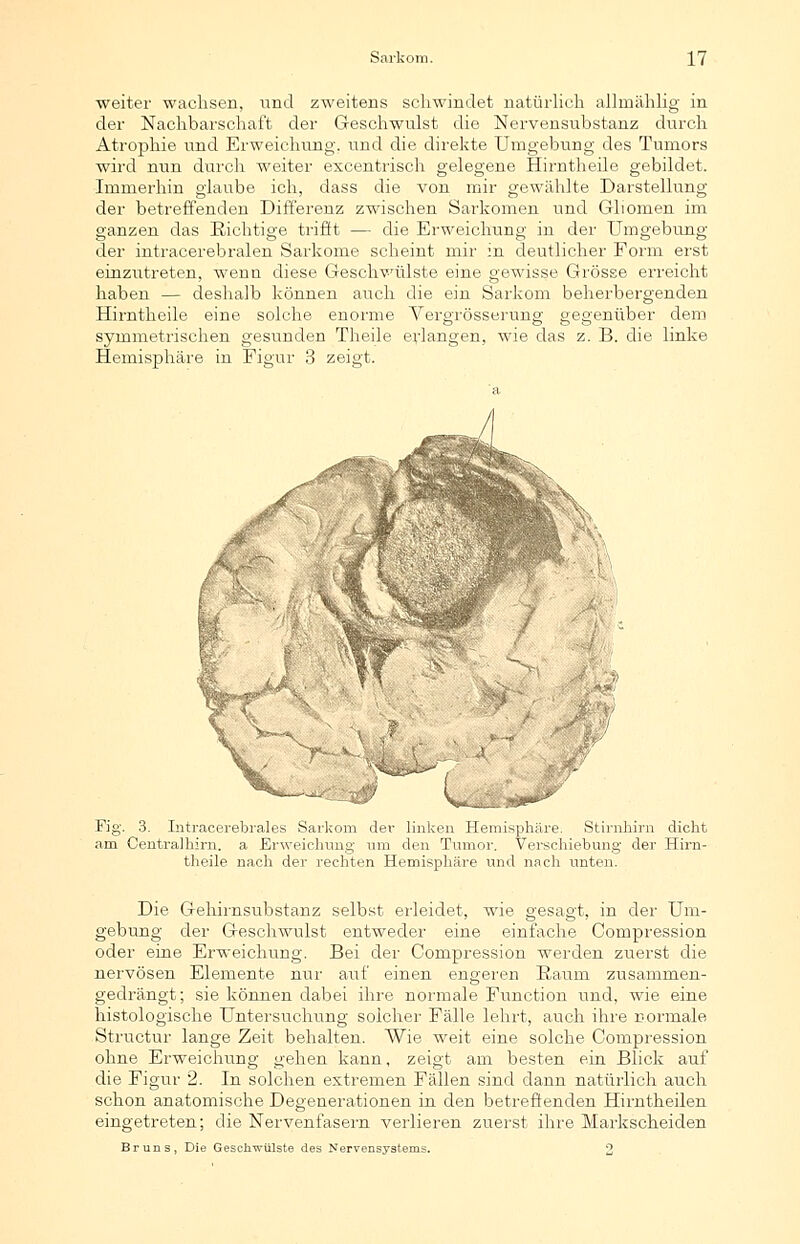 weiter wachsen, und zweitens schwindet natürlich allmählig in der Nachbarschaft der Geschwulst die Nervensubstanz durch Atrophie und Erweichung, und die direkte Umgebung des Tumors wird nun durch weiter excentrisch gelegene Hirntheile gebildet. Immerhin glaube ich, dass die von mir gewählte Darstellung der betreffenden Differenz zwischen Sarkomen und Gliomen im ganzen das Richtige trifft — die Erweichung in der Umgebung der intracerebralen Sarkome scheint mir in deutlicher Form erst einzutreten, wenn diese Geschwülste eine gewisse Grösse erreicht haben — deshalb können auch die ein Sarkom beherbergenden Hirntheile eine solche enorme Vergrösstsrung gegenüber dem symmetrischen gesunden Theile erlangen, wie das z. B. die linke Hemisphäre in Figur 3 zeigt. Fig. 3. Intracerebrales Sarkorn der linken Hemisphäre. Stirnhirn dicht am Centralhim. a Erweichung um den Tumor. Verschiebung der Hirn- theile nach der rechten Hemisphäre und nach unten. Die Gehirnsubstanz selbst erleidet, wie gesagt, in der Um- gebung der Geschwulst entweder eine einfache Compression oder eine Erweichung. Bei der Compression werden zuerst die nervösen Elemente nur auf einen engeren Kaum zusammen- gedrängt; sie können dabei ihre normale Function und, wie eine histologische Untersuchung solcher Fälle lehrt, auch ihre normale Structur lange Zeit behalten. Wie weit eine solche Compression ohne Erweichung gehen kann, zeigt am besten ein Blick auf die Figur 2. In solchen extremen Fällen sind dann natürlich auch schon anatomische Degenerationen in den betreffenden Hirntheilen eingetreten; die Nervenfasern verlieren zuerst ihre Markscheiden Bruns, Die Geschwülste des Nervensystems. 2