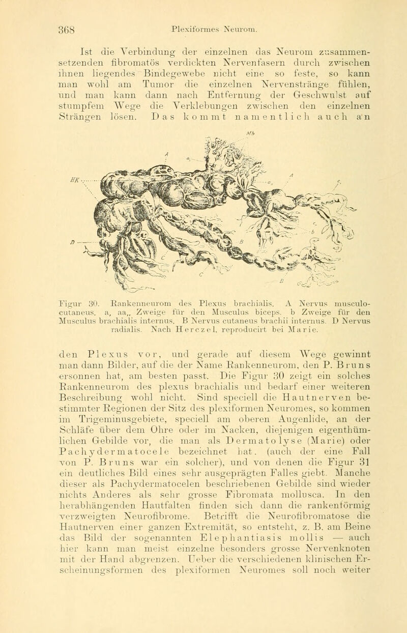 Ist die Verbindung der einzelnen das Neurom zusammen- setzenden fibromatös verdickten Nervenfasern durch zwischen ihnen liegendes Bindegewebe nicht eine so feste, so kann man wohl am Tumor die einzelnen Nervenstränge fühlen, und man kann dann nach Entfernung der Geschwulst auf stumpfem Wege die Verkleidungen zwischen den einzelnen Strängen lösen. Das kommt namentlich auch an HK;~ Rankenneurom des Plexus brachialis. A Nervus nmsculo- a, :ia„ Zweige für den Musculus bieeps. b Zweige für den Figur 30 cutaneus, Musculus brachialis internus. B Nervus cutaneus brachii internus radialis. Nach Herczel, reproducirt bei Marie. D Nervus den Plexus vor, und gerade auf diesem Wege gewinnt man dann Bilder, auf die der Name Bankenneurom, den P. Bruns ersonnen hat, am besten passt. Die Figur HO zeigt ein solches Bankenneurom des plexus brachialis und bedarf einer weiteren Beschreibung wohl nicht. Sind speciell die Hautnerven be- stimmter Begionen der Sitz des plexiformen Neuromes, so kommen im Trigeminusgebiete, speciell am oberen Augenlide, an der Schläfe über dem Ohre oder im Nacken, diejenigen eigenthüm- lichen Gebilde vor, die man als Dermatolyse (Marie) oder Pach y der m a tocele bezeichnet hat. (auch der eine Fall von P. Bruns war ein solcher), und von denen die Figur 81 ein deutliches Bild eines sehr ausgeprägten Falles giebt Manche dieser als Paebydennatocelen beschriebenen Gebilde sind wieder nichts Anderes als sehr grosse Fibromata mollusca. In den herabhängenden Hautfalten finden sich dann die rankenförmig verzweigten Neurofibrome. Betrifft die Neurofibromatose die Hautnerven einer ganzen Extremität, so entsteht, z. B. am Beine das Bild der sogenannten Elephantiasis mollis — auch hier kann man meist einzelne besonders grosse Nervenknoten mit der Hand abgrenzen. Ueber die verschiedenen klinischen Er- scheinungsformen des plexiformen Neuromes soll noch weiter