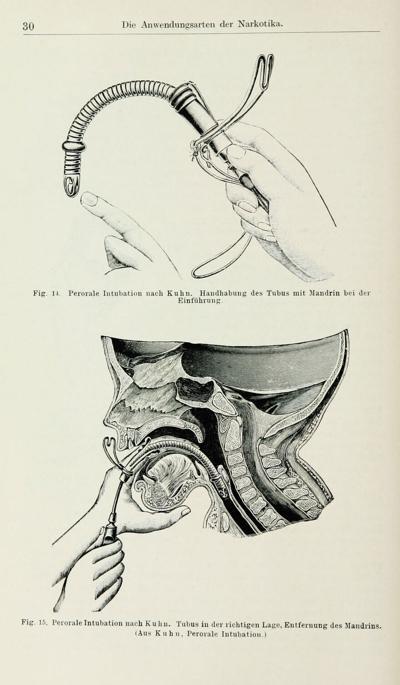 Fig. 14. Perorale Intubation nach Kuhn. Handhabung des Tubus mit Mandrin bei der Einführung. Fig. 15. Perorale Intubation nach Kuhn. Tubus in der richtigen Lage, Entfernung des Mawdri]
