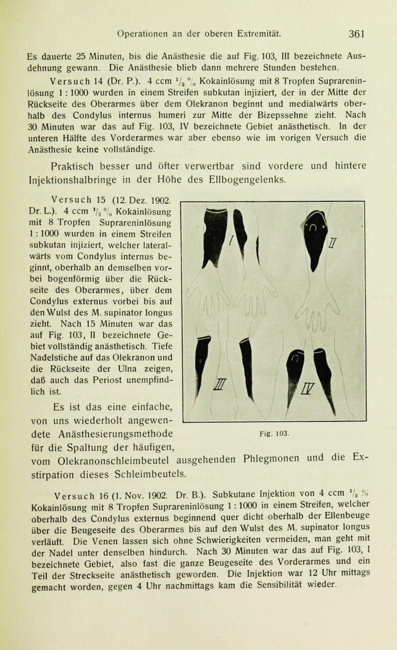 Es dauerte 25 Minuten, bis die Anästhesie die auf Fig. 103, 111 bezeichnete Aus- dehnung gewann. Die Anästhesie blieb dann mehrere Stunden bestehen. Versuch 14 (Dr. P.). 4 ccm 72 ,'„ Kokainlösung mit 8 Tropfen Suprarenin- lösung 1 : 1000 wurden in einem Streifen subkutan injiziert, der in der Mitte der Rückseite des Oberarmes über dem Olekranon beginnt und medialwärts ober- halb des Condylus internus humeri zur Mitte der Bizepssehne zieht. Nach 30 Minuten war das auf Fig. 103, IV bezeichnete Gebiet anästhetisch. In der unteren Hälfte des Vorderarmes war aber ebenso wie im vorigen Versuch die Anästhesie keine vollständige. Praktisch besser und öfter verwertbar sind vordere und hintere Injektionshalbringe in der Höhe des Ellbogengelenks. Versuch 15 (12. Dez. 1902. Dr. L.). 4 ccm V2 % Kokainlösung mit 8 Tropfen Suprareninlösung 1 : 1000 wurden in einem Streifen subkutan injiziert, welcher lateral- wärts vom Condylus internus be- ginnt, oberhalb an demselben vor- bei bogenförmig über die Rück- seite des Oberarmes, über dem Condylus externus vorbei bis auf den Wulst des M. supinator longus zieht. Nach 15 Minuten war das auf Fig. 103, II bezeichnete Ge- biet vollständig anästhetisch. Tiefe Nadelstiche auf das Olekranon und die Rückseite der Ulna zeigen, daß auch das Periost unempfind- lich ist. Es ist das eine einfache, von uns wiederholt angewen- dete Anästhesierungsmethode für die Spaltung der häufigen, vom Olekranonschleimbeutel aus; stirpation dieses Schleimbeutels. Versuch 16 (1. Nov. 1902. Dr. B.). Subkutane Injektion von 4 ccm »/, % Kokainlösung mit 8 Tropfen Suprareninlösung 1 : 1000 in einem Streifen, welcher oberhalb des Condylus externus beginnend quer dicht oberhalb der Ellenbeuge über die Beugeseite des Oberarmes bis auf den Wulst des M. supinator longus verläuft. Die Venen lassen sich ohne Schwierigkeiten vermeiden, man geht mit der Nadel unter denselben hindurch. Nach 30 Minuten war das auf Fig. 103, I bezeichnete Gebiet, also fast die ganze Beugeseite des Vorderarmes und ein Teil der Streckseite anästhetisch geworden. Die Injektion war 12 Uhr mittags gemacht worden, gegen 4 Uhr nachmittags kam die Sensibilität wieder. Fig. 103. sehenden Phlegmonen und die Ex-