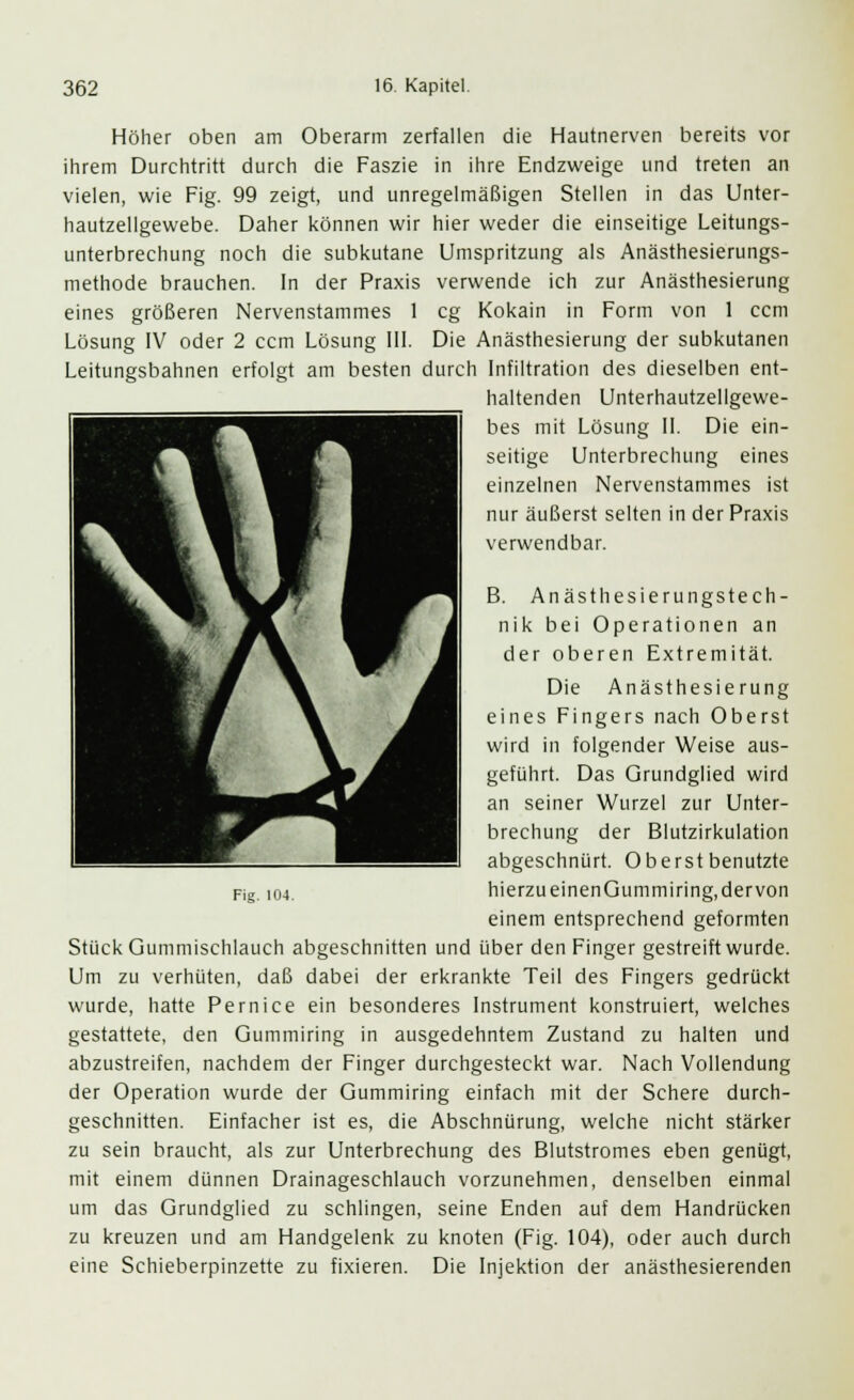 Höher oben am Oberarm zerfallen die Hautnerven bereits vor ihrem Durchtritt durch die Faszie in ihre Endzweige und treten an vielen, wie Fig. 99 zeigt, und unregelmäßigen Stellen in das Unter- hautzellgewebe. Daher können wir hier weder die einseitige Leitungs- unterbrechung noch die subkutane Umspritzung als Anästhesierungs- methode brauchen. In der Praxis verwende ich zur Anästhesierung eines größeren Nervenstammes 1 cg Kokain in Form von 1 ccm Lösung IV oder 2 ccm Lösung III. Die Anästhesierung der subkutanen Leitungsbahnen erfolgt am besten durch Infiltration des dieselben ent- haltenden Unterhautzellgewe- bes mit Lösung II. Die ein- seitige Unterbrechung eines einzelnen Nervenstammes ist nur äußerst selten in der Praxis verwendbar. B. Anästhesierungstech- nik bei Operationen an der oberen Extremität. Die Anästhesierung eines Fingers nach Oberst wird in folgender Weise aus- geführt. Das Grundglied wird an seiner Wurzel zur Unter- brechung der Blutzirkulation abgeschnürt. Oberst benutzte hierzu einen Gummi ring, der von einem entsprechend geformten Stück Gummischlauch abgeschnitten und über den Finger gestreift wurde. Um zu verhüten, daß dabei der erkrankte Teil des Fingers gedrückt wurde, hatte Pernice ein besonderes Instrument konstruiert, welches gestattete, den Gummiring in ausgedehntem Zustand zu halten und abzustreifen, nachdem der Finger durchgesteckt war. Nach Vollendung der Operation wurde der Gummiring einfach mit der Schere durch- geschnitten. Einfacher ist es, die Abschnürung, welche nicht stärker zu sein braucht, als zur Unterbrechung des Blutstromes eben genügt, mit einem dünnen Drainageschlauch vorzunehmen, denselben einmal um das Grundglied zu schlingen, seine Enden auf dem Handrücken zu kreuzen und am Handgelenk zu knoten (Fig. 104), oder auch durch eine Schieberpinzette zu fixieren. Die Injektion der anästhesierenden