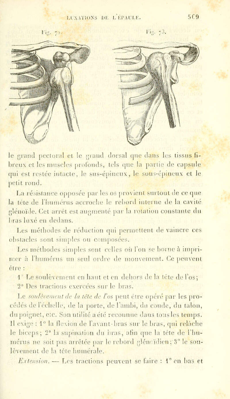 LUXATIONS Di: L l.l'AU.F. 5C9 Fil li ;. 73. le grand pectoral el !e grand dorsal que dans les tissus fi- breux et les muscles profonds, tels que la partie de capsule qui est restée intacte, le sus-épineux, le sous-épineux et le petit rond. La résistance opposée par les os provient surtout de ce (pie la tête de l'humérus accroche le rebord interne de la cavité gîénoïde. Cet arrêt est augmenté par la rotation constante du laas luxé en dedans. Les méthodes de réduction qui permettent de vaincre ces obstacles sont simples ou composées. Les méthodes simples sont celles où Ton se borne à impri- mer à l'humérus un seul ordre de mouvement. Ce peuvent être : 1° Le soulèvement en haut et en dehors de la tête de l'os; 2° Des tractions exercées sur le bras. Le soulèvement de la tête de l'os peut être opéré par les pro- cédés de l'échelle, de la porte, de i'anibi, du coude, du talon, du poignet, etc. Son utilité a été reconnue dans tous les temps. Il exige : 1 la flexion de lavant-bras sur le bras, qui relâche le biceps; 2° la supination du bras, afin que la tête de l'hu- mérus ne soit pas arrêtée par le rebord gléncïdien; 3° le sou- lèvement de la tête humérale. Extension. — Les tractions peuvent se faire : 1° en bas et
