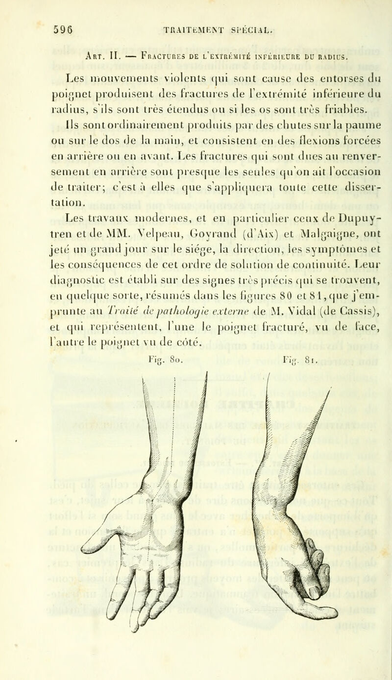 Art. II. — Fractures de l'extrémité inférieure du radius. Les mouvements violents qui sont cause des entorses du poignet produisent des fractures de l'extrémité inférieure du radius, s'ils sont très étendus ou si les os sont très friables. Ils sont ordinairement produits par des chutes sur la paume ou sur le dos de la main, et consistent en des flexions forcées en arrière ou en avant. Les fractures qui sont dues au renver- sement en arrière sont presque les seules qu'on ait l'occasion de traiter; c'est à elles que s'appliquera toute cette disser- tation. Les travaux modernes, et en particulier ceux de Dupuy- tren et de MM. Velpeau, Goyrand (d'Aix) et Malgaignje, ont jeté un grand jour sur le siège, la direction, les symptômes et les conséquences de cet ordre de solution de continuité. Leur diagnostic est établi sur des signes très précis qui se trouvent, en quelque sorte, résumés dans les ligures 80 et 8 1, (pie j'em- prunte an Traité de pathologie externe de M. Vidal (de Cassis), et qui représentent, l'une le poignet fracturé, vu de face, l'autre le poignet vu de côté. Fiff. 8o. Fi>. 8i.