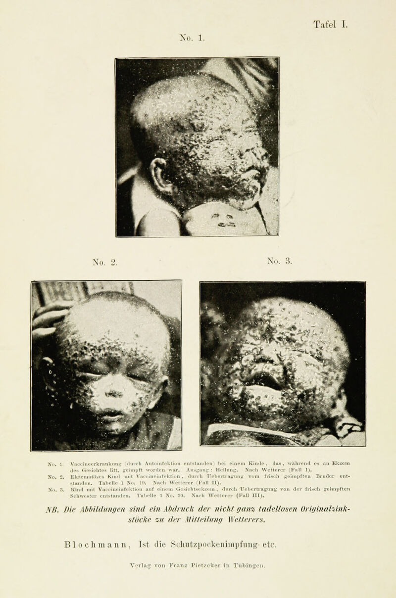 X. 1. No. -'. Nu. :?. '1 ■ *- * % ■ ^^flr' X... l Vaccinecrkrankung durch Autoinfektion entstanden bei einr-m Kinde, da«, während es an Kk/.cni des Gesichtes litt, gciinpfl worden war. Ausgang : Heilung, Nai li Wetterer Fall I). No. 2. Ekzematöses Kind mit Vaccineinfektion . durch Ucbertragung vi>m frisch geimpften Bruder ent- sinn.im. Tabelle i -\. 19. Nach Wetterer 1'nii II). No. 3. Kind mit Vacclneinfektion auf einem Gesichtaekzem, durch (Jcbertragung von der frisch geimpften Schwester entstanden, Tai-cdle i No. '2». Nach Wetterer (Kall III). AB. Die Abbildungen sind ein Abdruck der nicht ganz tadellosen Originalzink- stocke ■;■>/ der Mitteilung Wetterers. Bloch mann, I-*t die Schutzpockenimpfung-etc.