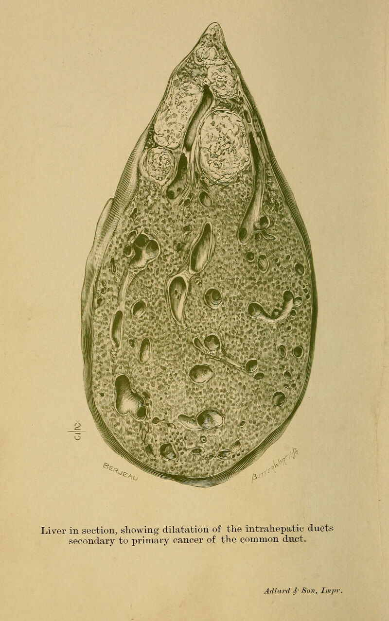 Liver in section, showing dilatation of the intrahepatic ducts secondary to primary cancer of the common duct. Adlard 4' &ow> Impr