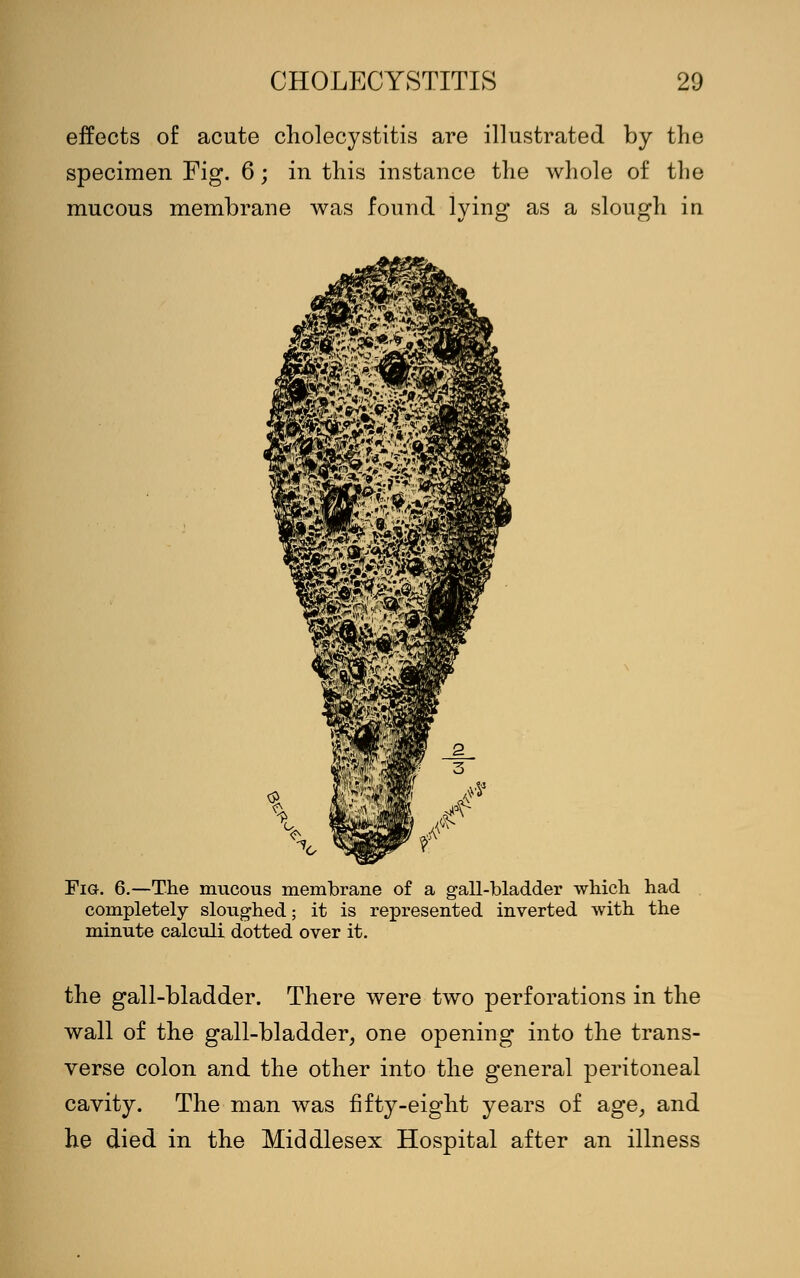 effects of acute cholecystitis are illustrated by the specimen Fig. 6; in this instance the whole of the mucous membrane was found lying as a slough in Fig. 6.—The mucous membrane of a gall-bladder which had completely sloughed; it is represented inverted with the minute calculi dotted over it. the gall-bladder. There were two perforations in the wall of the gall-bladder, one opening into the trans- verse colon and the other into the general peritoneal cavity. The man was fifty-eight years of age, and he died in the Middlesex Hospital after an illness