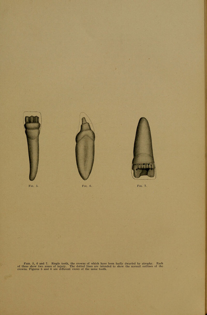 of these show two zones of injury. The dotted lines are intended to show the normal outlines of the crowns. Figures 5 and 6 are different views of the same tooth.