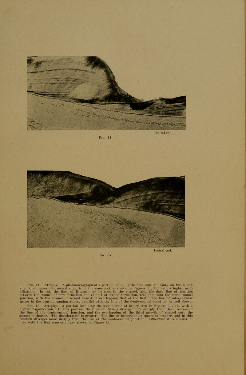 ' 14. the lial. higher mag- of junction ento-enamel titerglobular nification. In this the lines <.f liitzcus may he seen in the enamel, also the dart junction, with the enamel of second formation overlapping that of the first. The lir spaces in the dentin, running almost parallel with the line of the dento-enamel junction, is well shown. Fin. 15. Atrophy. A portion including the second zone of injury seen in Figures 11. 12, with a higher magnification. In this position the lines of Ritzeus diverge more sharply from the direction of the line of the dento-enamel junction, and the overlapping of the third growth of enamel onto the second is shorter. The discoloration is greater. The line of interglobular spaces is broader, and in this position diverges more sharply from the line of the dento-enamel junction. Otherwise it is similar in