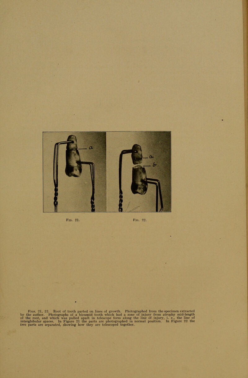 Figs. 21, 22. Root of tooth parted on lines of growth. Photographed from the specimen extracted by the author. Photographs of a bicuspid tooth which had a zone of injury from atrophy mid-length of the root, and which was pulled apart in telescope form along the line of injury, i. e., the line of interglobular spaces. In Figure 21 the parts are photographed in normal position. In Figure 22 the two parts are separated, showing how they are telescoped together.