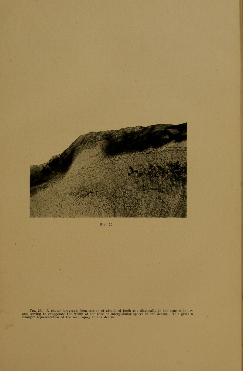 and serving to exaggerate the width of the zone of interglobular spaces in the dentin. This gives a stronger representation of the real injury to the dentin.