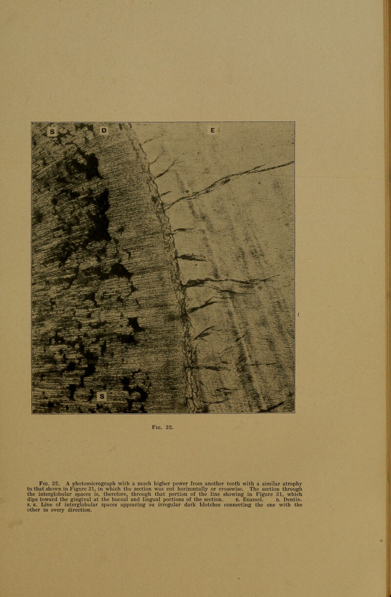 Fig. 32. A photomicrograph with a much higher power from another tooth with a similar atrophy to that shown in Figure 31, in which the section was cut horizontally or crosswise. The section through the interglobular spaces is, therefore, through that portion of the line showing in Figure 31, which dips toward the gingival at the buccal and lingual portions of the section. E. Enamel. D. Dentin. s. s. Line of interglobular spaces appearing as irregular dark blotches connecting the one with the other in every direction.