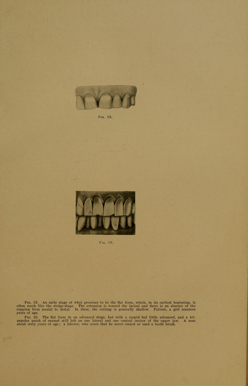 m -r f • fftf Fig. 52. An early stage of what promises to be the flat form, which, in its earliest beginning, is often much like the wedge-shape. The extension is toward the incisal and there is an absence of the cupping from mesial to distal. In these, the cutting is generally shallow. Patient, a girl nineteen years of age. Fig. 53. The flat form in an advanced stage, but with a cuspid but little advanced, and a tri- angular patch of enamel still left on one lateral and one central incisor of the upper jaw. A man about sixty years of age; a laborer, who avers that he never owned or used a tooth brush.