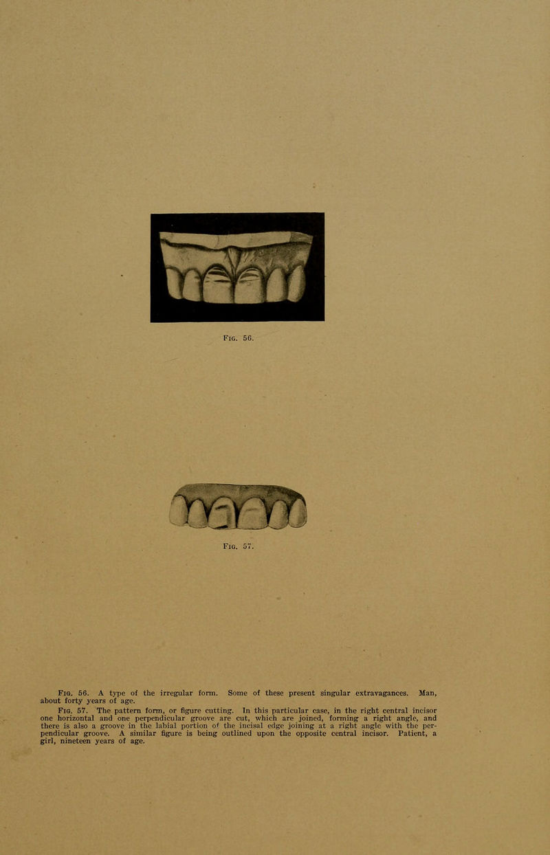 Ullii yvzY'ff* Fig. 56. A type of the irregular form. Some of these present singular extravagances. Man, about forty years of age. Fia. 57. The pattern form, or figure cutting. In this particular case, in the right central incisor one horizontal and one perpendicular groove are cut, which are joined, forming a right angle, and there is also a groove in the labial portion of the incisal edge joining at a right angle with the per- pendicular groove. A similar figure is being outlined upon the opposite central incisor. Patient, a girl, nineteen years of age.