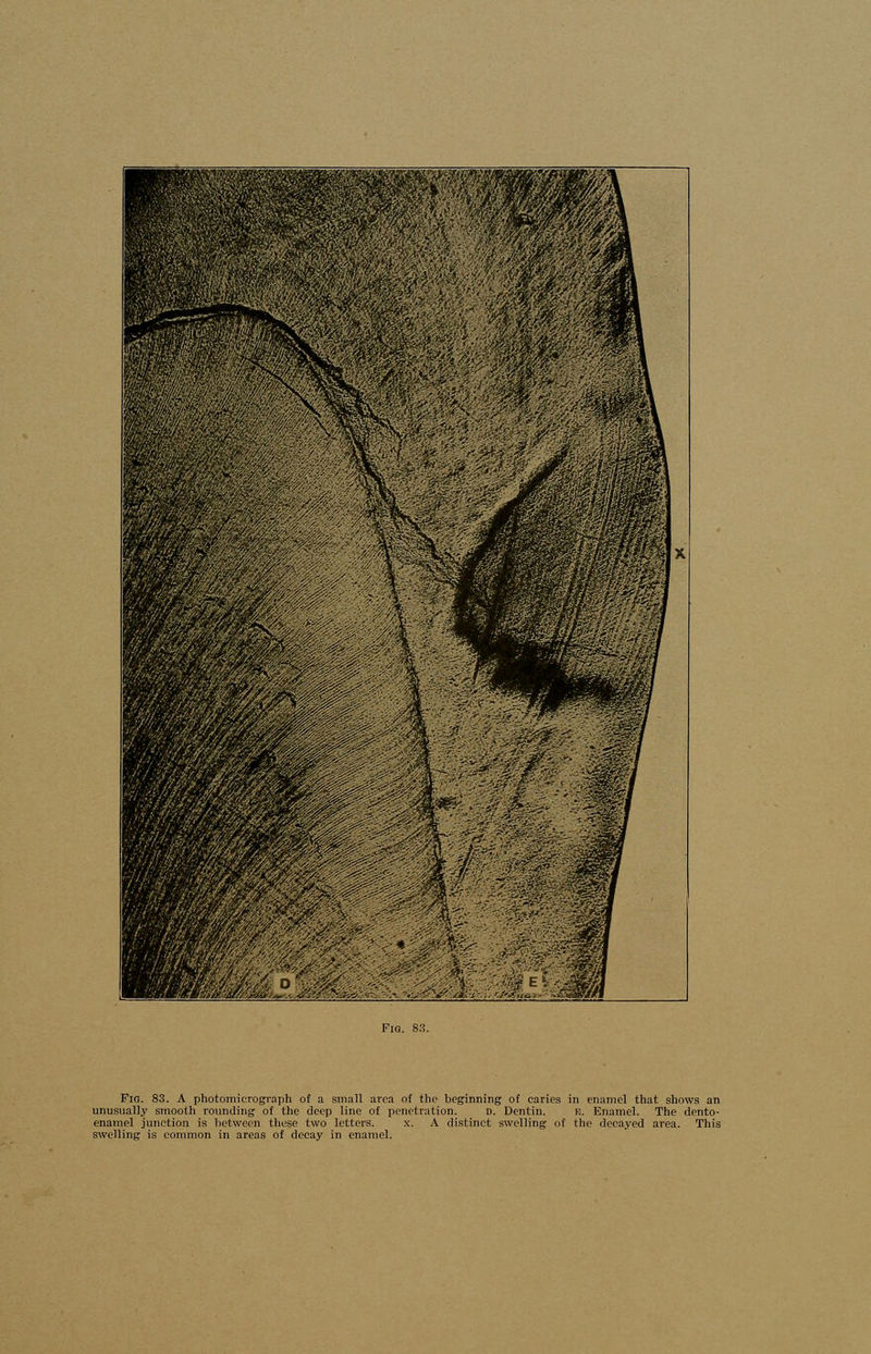 Fir.. 83. A photomicrograph of a small area of the beginning of caries in enamel that shows an unusually smooth rounding of the deep line of penetration. d. Dentin. e. Enamel. The dento- enamel junction is between these two letters. x. A distinct swelling nf the decayed area. This swelling is common in areas of decay in enamel.