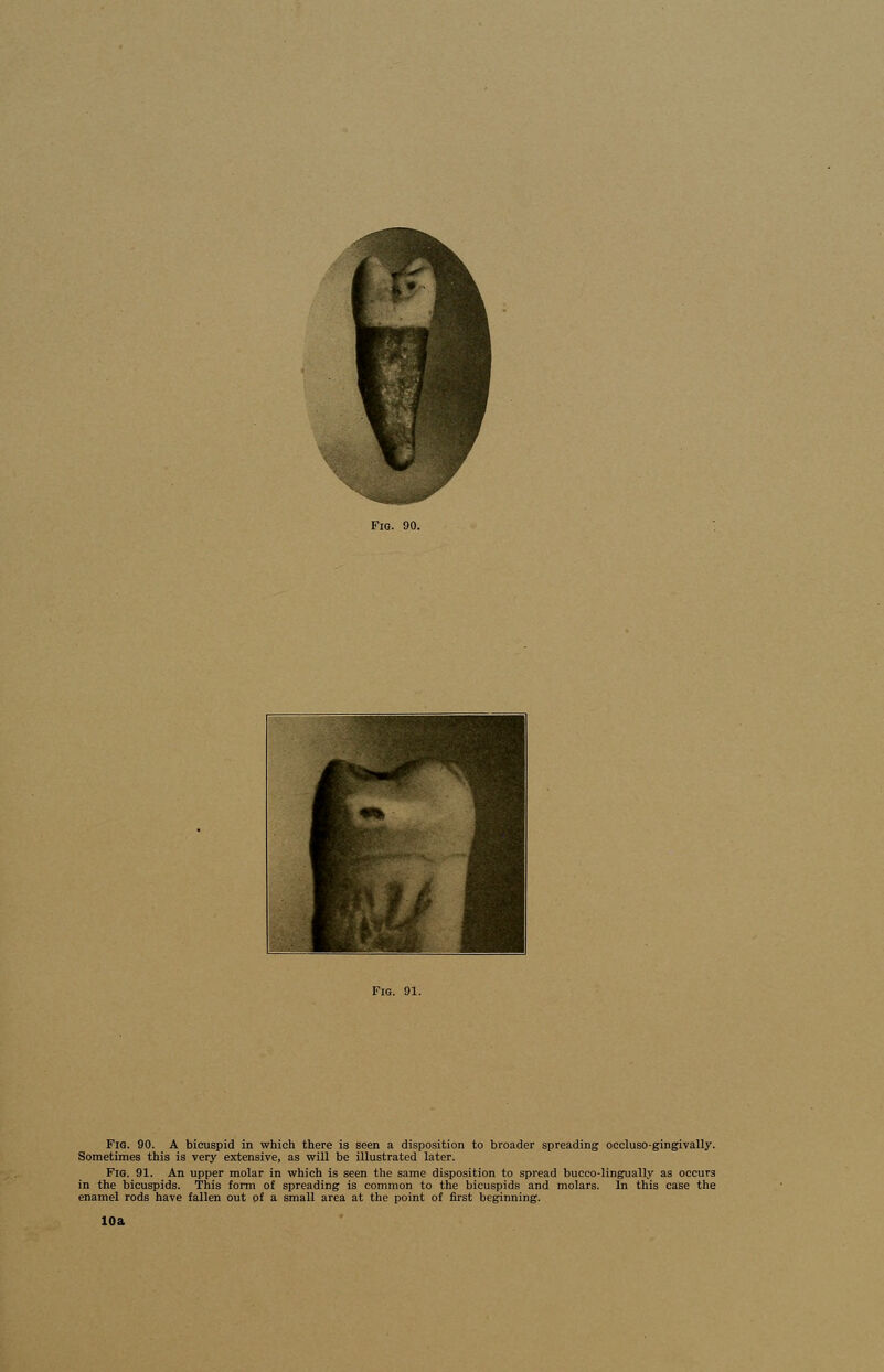 Sometimes this is very extensive, as will be illustrated later. Fig. 91. An upper molar in which is seen the same disposition to spread bucco-lingually as occurs in the bicuspids. This form of spreading is common to the bicuspids and molars. In this case the enamel rods have fallen out of a small area at the point of first beginning. 10a