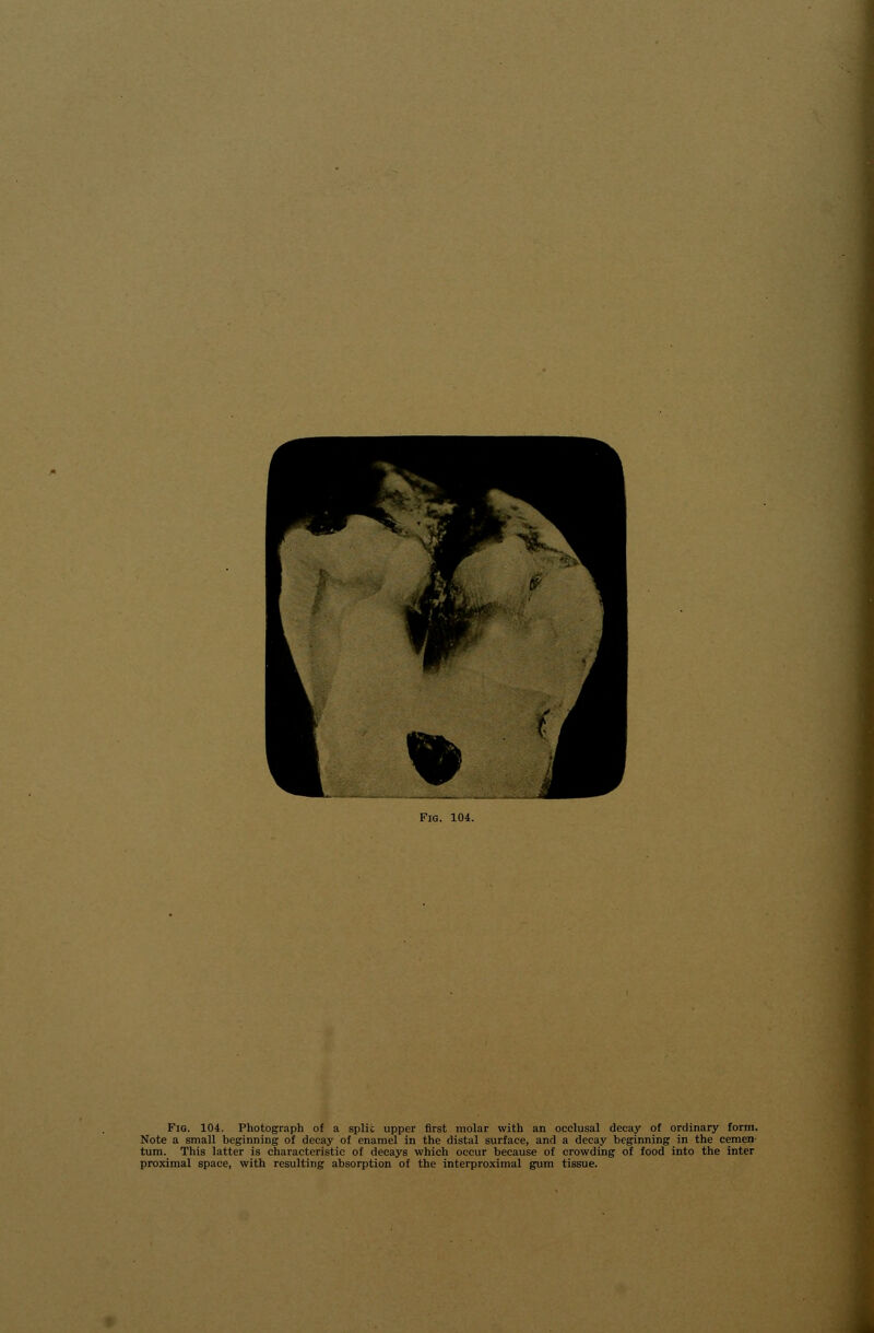 Note a small beginning of decay of enamel in the distal surface, and a decay beginning in the cemen- turn. This latter is characteristic of decays which occur because of crowding of food into the inter proximal space, with resulting absorption of the interproximal gum tissue.