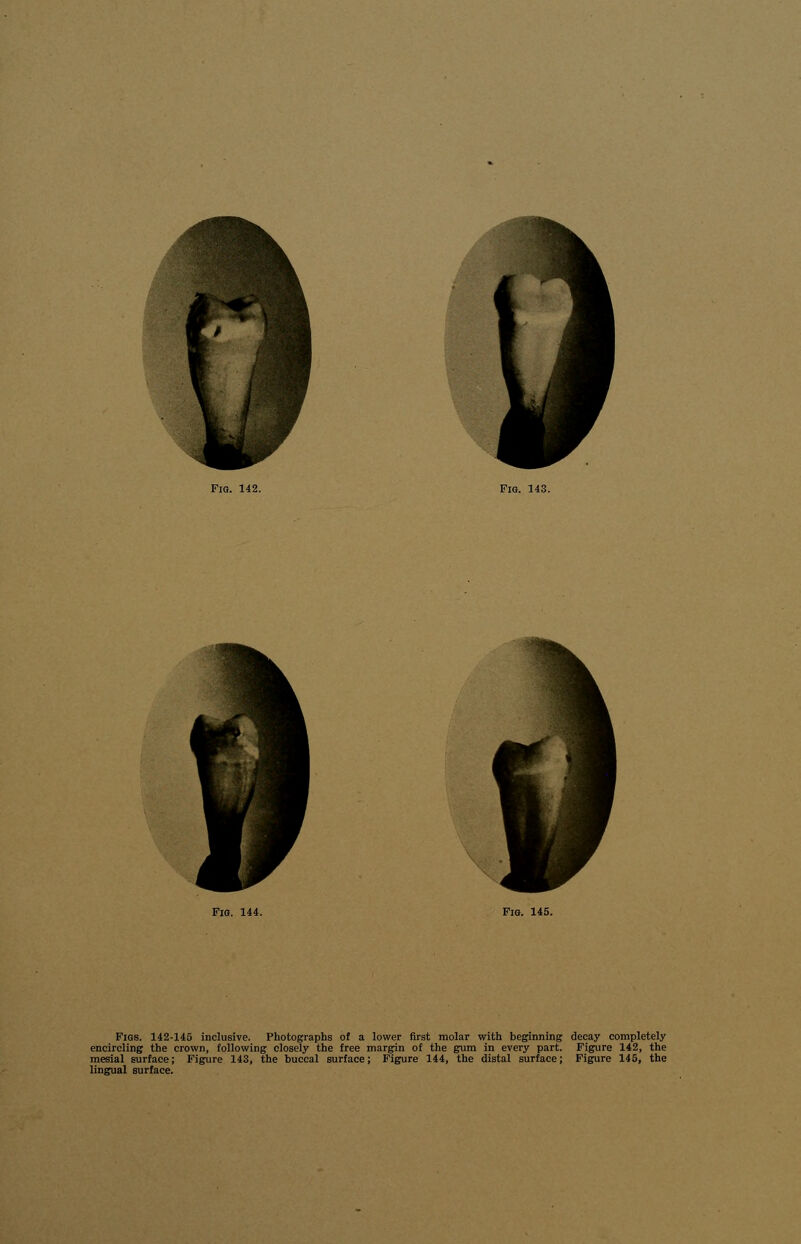 Figs. 142-145 inclusive. Photographs of a lower first molar with beginning decay completely encircling the crown, following closely the free margin of the gum in every part. Figure 142, the mesial surface; Figure 143, the buccal surface; Figure 144, the distal surface; Figure 145, the lingual surface.