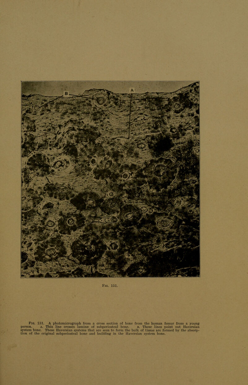 Fig. 151. A photomicrograph from a cross section of bono from the human femur from a young person. a. This line crosses laminae of subperiosteal bone. ii. These lines point out Haversian system bone. These Haversian systems that are seen to form the bulk of tissue are formed by the absorp- tion of the original subperiosteal bone and building in the Haversian system bone.