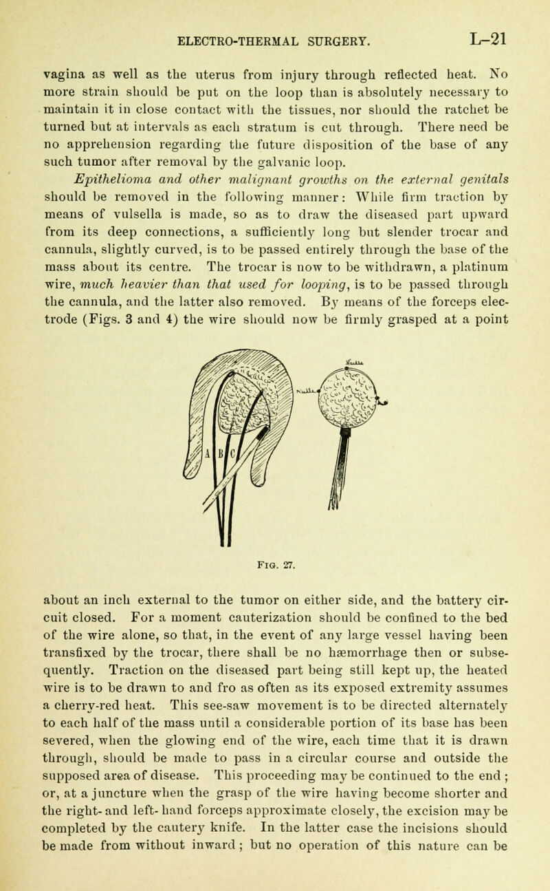 vagina as well as the uterus from injury through reflected heat. No more strain should be put on the loop than is absolutely necessary to maintain it in close contact with the tissues, nor should the ratchet be turned but at intervals as each stratum is cut through. There need be no apprehension regarding the future disposition of the base of any such tumor after removal by the galvanic loop. Epithelioma and other malignant growths on the external genitals should be removed in the following manner: While firm traction by means of vulsella is made, so as to draw the diseased part upward from its deep connections, a sufficiently long but slender trocar and cannula, slightly curved, is to be passed entirely through the base of the mass about its centre. The trocar is now to be withdrawn, a platinum wire, much heavier than that used for looping, is to be passed through the cannula, and the latter also removed. By means of the forceps elec- trode (Figs. 3 and 4) the wire should now be firmly grasped at a point Fio. 27. about an inch external to the tumor on either side, and the battery cir- cuit closed. For a moment cauterization should be confined to the bed of the wire alone, so that, in the event of any large vessel having been transfixed by the trocar, there shall be no haemorrhage then or subse- quently. Traction on the diseased part being still kept up, the heated wire is to be drawn to and fro as often as its exposed extremity assumes a cherry-red heat. This see-saw movement is to be directed alternately to each half of the mass until a considerable portion of its base has been severed, when the glowing end of the wire, each time that it is drawn through, should be made to pass in a circular course and outside the supposed area of disease. This proceeding may be continued to the end ; or, at a juncture when the grasp of the wire having become shorter and the right- and left- hand forceps approximate closely, the excision may be completed by the cautery knife. In the latter case the incisions should be made from without inward ; but no operation of this nature can be