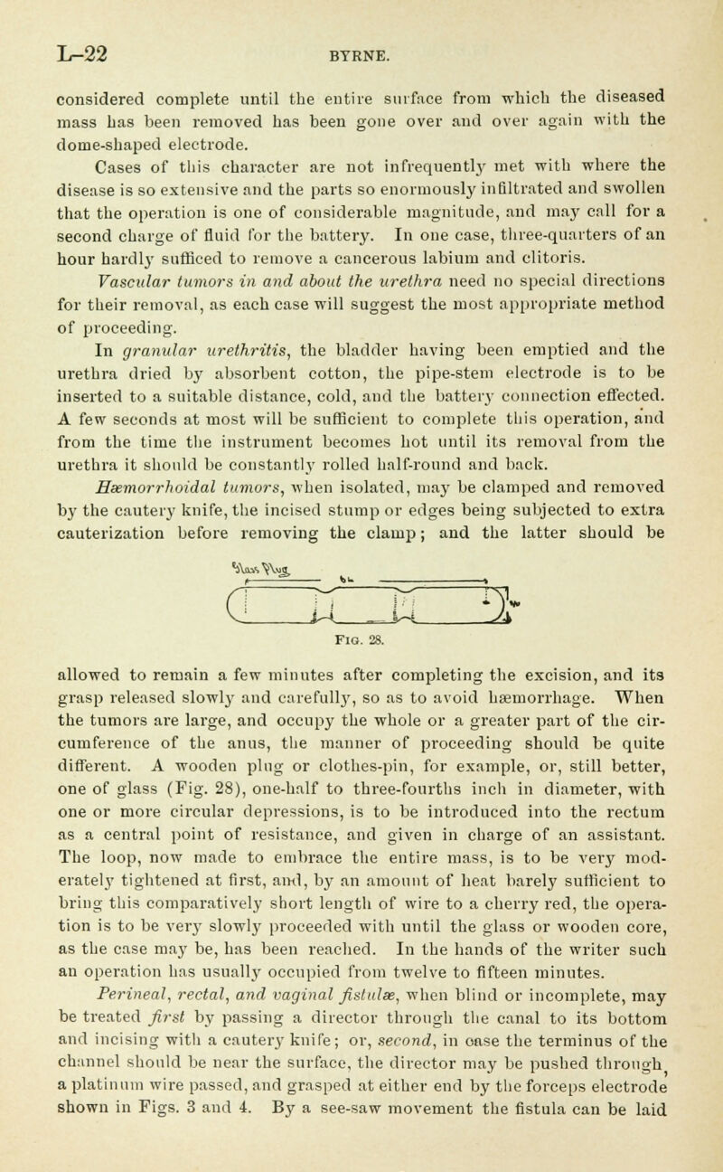 considered complete until the entire surface from which the diseased mass has been removed has been gone over and over again with the dome-shaped electrode. Cases of this character are not infrequently met with where the disease is so extensive and the parts so enormously infiltrated and swollen that the operation is one of considerable magnitude, and may call for a second charge of fluid for the battery. In one case, three-quarters of an hour hardly sufficed to remove a cancerous labium and clitoris. Vascular tumors in and about the urethra need no special directions for their removal, as each case will suggest the most appropriate method of proceeding. In granular urethritis, the bladder having been emptied and the urethra dried by absorbent cotton, the pipe-stem electrode is to be inserted to a suitable distance, cold, and the battery connection effected. A few seconds at most will be sufficient to complete this operation, and from the time the instrument becomes hot until its removal from the urethra it should be constantly rolled half-round and back. Hemorrhoidal tumors, when isolated, may be clamped and removed by the cautery knife, the incised stump or edges being subjected to extra cauterization before removing the clamp; and the latter should be 0 11 Pi n~ Fig. 28. allowed to remain a few minutes after completing the excision, and its grasp released slowly and carefully, so as to avoid haemorrhage. When the tumors are large, and occupy the whole or a greater part of the cir- cumference of the anus, the manner of proceeding should be quite different. A wooden ping or clothes-pin, for example, or, still better, one of glass (Fig. 28), one-half to three-fourths inch in diameter, with one or more circular depressions, is to be introduced into the rectum as a central point of resistance, and given in charge of an assistant. The loop, now made to embrace the entire mass, is to be very mod- erately tightened at first, ami, by an amount of heat barely sufficient to bring this comparatively short length of wire to a cherry red, the opera- tion is to be ver}' slowly proceeded with until the glass or wooden core, as the case may be, has been reached. In the hands of the writer such an operation has usually occupied from twelve to fifteen minutes. Perineal, rectal, and vaginal fistulas, when blind or incomplete, may be treated first by passing a director through the canal to its bottom and incising with a cauteiy knife; or, second, in oase the terminus of the channel should be near the surface, the director may be pushed through a platinum wire passed, and grasped at either end by the forceps electrode shown in Figs. 3 and 4. By a see-saw movement the fistula can be laid
