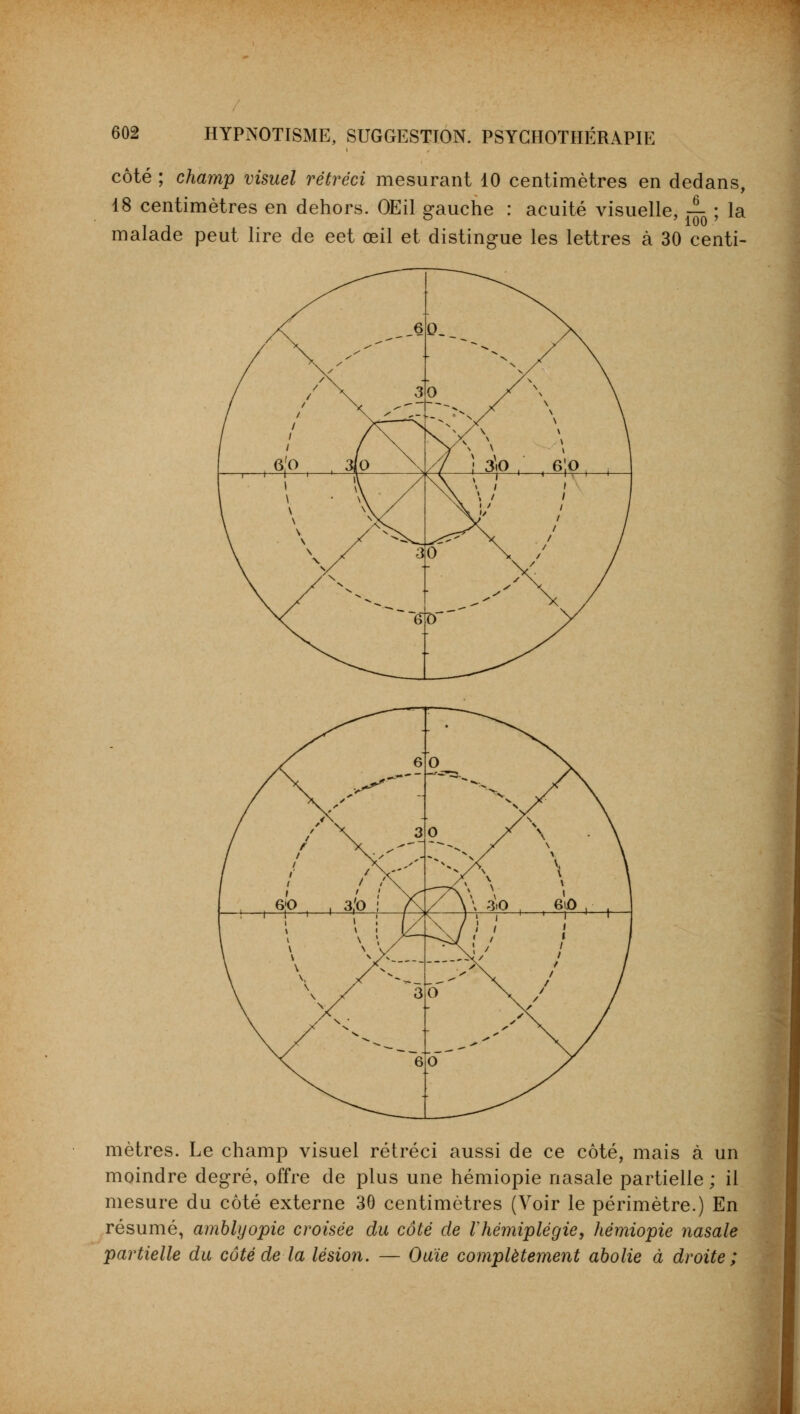 côté ; champ visuel rétréci mesurant 10 centimètres en dedans, 18 centimètres en dehors. OEil gauche : acuité visuelle, ^ ; la malade peut lire de eet œil et distingue les lettres à 30 centi- • ^^^v 6 b V>^~ ^N * N v. N / * s \ / r X 3 0 / N ' \ / t / / / / •^ / \ \ 1 \ / / i /X ■—7\ \ ^ V 1 , 6P , , 3('0 ! X / \\ io . Giô , 1 ! Il' \ ! \ i \ \ / X / ï ' \ / ' ' i 1 i i \ \ N \y ^\î ' / \ \ \ X. is// / / \ \ /X •\ / / / / \ /a * ** — -—*' X. / / \ \ \ \ / 3 o \ / / / / \ \ / \ • y >» N. s> — , .— * 6 0 mètres. Le champ visuel rétréci aussi de ce côté, mais à un moindre degré, offre de plus une hémiopie nasale partielle ; il mesure du côté externe 36 centimètres (Voir le périmètre.) En résumé, amblyopie croisée du côté de l'hémiplégie, hémiopie nasale partielle du côté de la lésion. — Ouïe complètement abolie à droite;