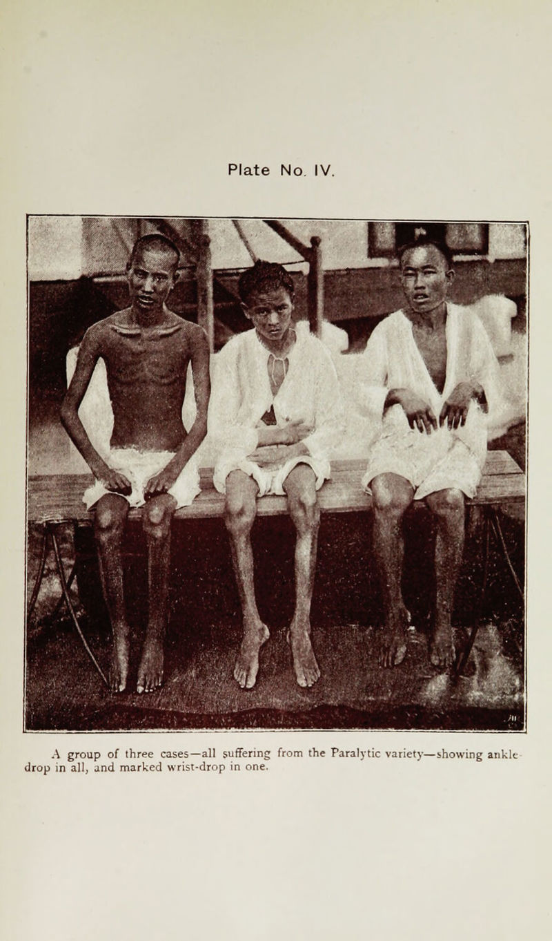 A group of three cases—all suffering from the Paralytic variety—showing ankle drop in all, and marked wrist-drop in one.