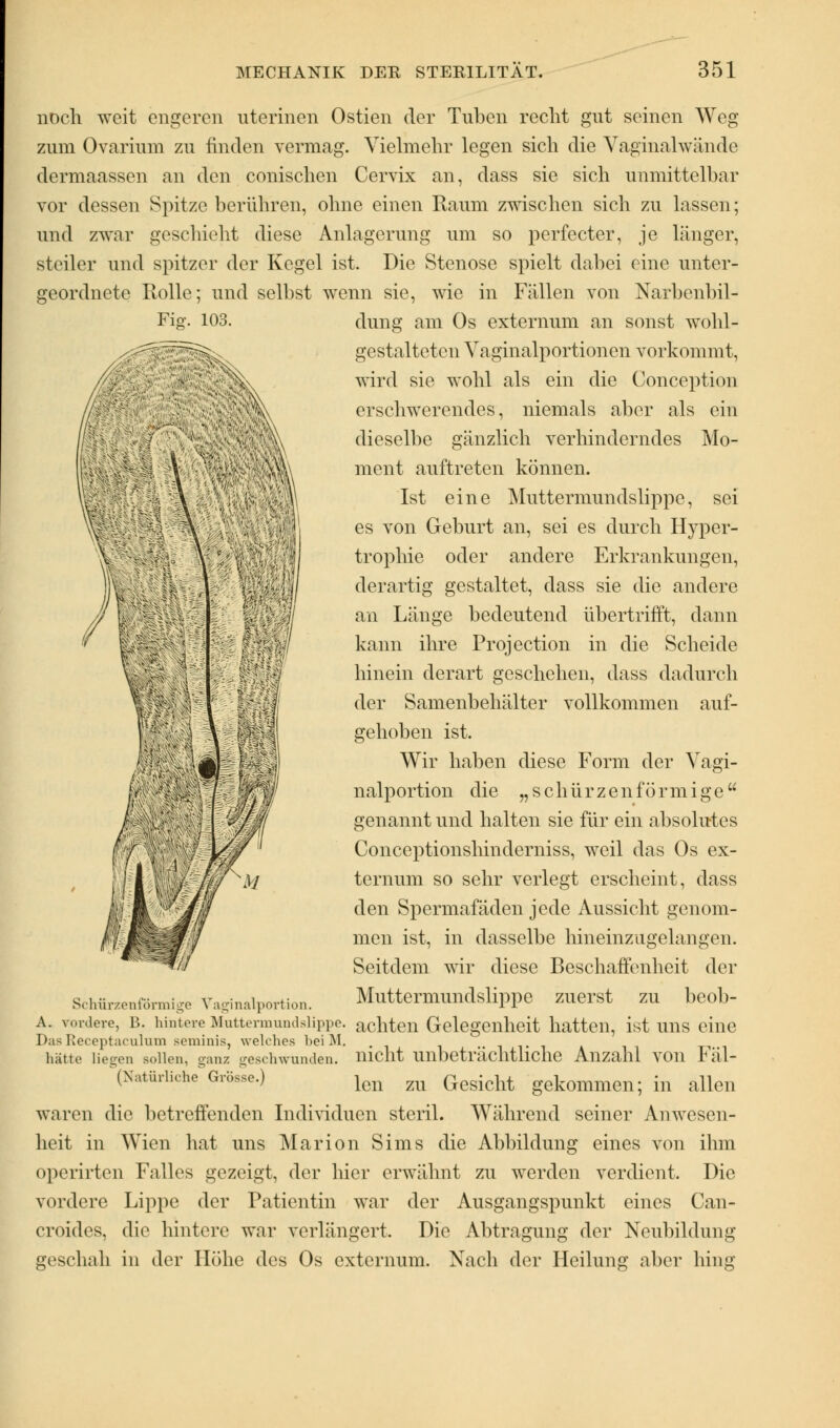noch weit engeren nterinen Ostien der Tuben recht gut seinen Weg zum Ovarium zu finden vermag. Vielmehr legen sich die Vaginalwände dermaassen an den conischen Cervix an, dass sie sich unmittelbar vor dessen Spitze berühren, ohne einen Raum zwischen sich zu lassen; und zwar geschieht diese Anlagerung um so perfecter, je länger, steiler und spitzer der Kegel ist. Die Stenose spielt dabei eine unter- geordnete Rolle; und selbst wenn sie, wie in Fällen von Narbenbil- Fig. 103. Schürzenförmige Vaginalportion. dung am Os externum an sonst wohl- gestalteten Vaginalportionen vorkommt, wird sie wohl als ein die Conception erschwerendes, niemals aber als eiu dieselbe gänzlich verhinderndes Mo- ment auftreten können. Ist eine Muttermundslippc, sei es von Geburt an, sei es durch H}rper- trophie oder andere Erkrankungen, derartig gestaltet, dass sie die andere an Länge bedeutend übertrifft, dann kann ihre Projection in die Scheide hinein derart geschehen, dass dadurch der Samenbehälter vollkommen auf- gehoben ist. Wir haben diese Form der Vagi- nalportion die „ s c h ü r z e n f ö r m i g e  genannt und halten sie für ein absolutes Conceptionshinderniss, weil das Os ex- ternum so sehr verlegt erscheint, dass den Spermafäden jede Aussicht genom- men ist, in dasselbe Irineinzugelangen. Seitdem wir diese Beschaffenheit der Muttermundslippe zuerst zu bcob- a. vordere, B. hintere Muttermundslippc. achten Gelegenheit hatten, ist uns eine Das Receptaculum seminis, welches beiM, hätte liegen sollen, ganz geschwunden, nicht unbeträchtliche Anzahl von Fäl- '(Natürliche'Grösse.) len m Gesicht gekommen; in allen waren die betreffenden Individuen steril. Während seiner Anwesen- heit in Wien hat uns Marion Sims die Abbildung eines von ihm operirteii Falles gezeigt, der hier erwähnt zu werden verdient. Die vordere Lippe der Patientin war der Ausgangspunkt eines Can- croides, die hintere war verlängert. Die Abtragung der Neubildung geschah in der Höhe des Os externum. Nach der Heilung aber hing