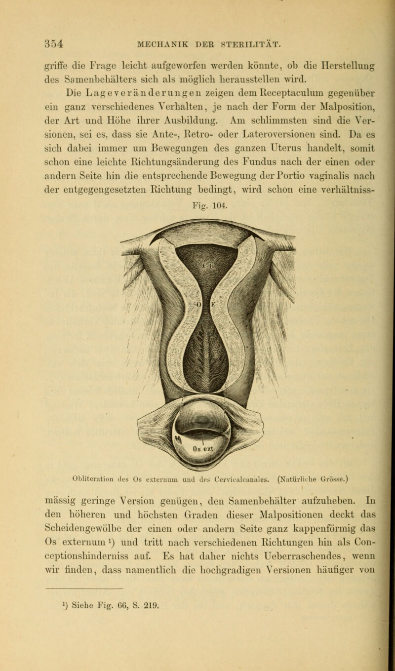 griffe die Frage leicht aufgeworfen werden könnte, ob die Herstellung des Samenbehälters sich als möglich herausstellen wird. Die Lageveränderungen zeigen dein Receptaculum gegenüber ein ganz verschiedenes Verhalten, je nach der Form der Malposition, der Art und Höhe ihrer Ausbildung. Am schlimmsten sind die Ver- sionen, sei es, dass sie Ante-, Retro- oder Lateroversionen sind. Da es sich dabei immer um Bewegungen des ganzen Uterus handelt, somit schon eine leichte Richtungsänderung des Fundus nach der einen oder andern Seite hin die entsprechende Bewegung der Portio vaginalis nach der entgegengesetzten Richtung bedingt, ward schon eine verhältniss- Fijr. 104. Obliteration des üs externum und des Cervicalcanales. (Natürliche Grösse.) massig geringe Version genügen, den Samenbehälter aufzuheben. In den höheren und höchsten Graden dieser Malpositionen deckt das Scheidengewölbe der einen oder andern Seite ganz kappenförmig das Os externum l) und tritt nach verschiedenen Richtungen hin als Con- ceptionshinderniss auf. Es hat daher nichts Ueberraschendes, wenn wir finden, dass namentlich die hochgradigen Versionen häufiger von !) Siehe Fig. GG, S. 219.
