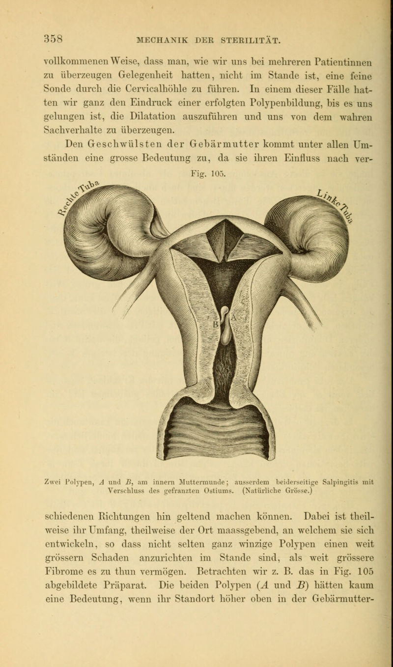 vollkommenen Weise, dass man. wie wir uns bei mehreren Patientinnen zu überzeugen Gelegenheit hatten, nicht im Stande ist, eine feine Sonde durch die Cervicalhöhle zu führen. In einem dieser Fälle hat- ten wir ganz den Eindruck einer erfolgten Polypenbildung, bis es uns gelungen ist, die Dilatation auszuführen und uns von dem wahren Sachverhalte zu überzeugen. Den Geschwülsten der Gebärmutter kommt unter allen Um- ständen eine grosse Bedeutung zu, da sie ihren Einfluss nach ver- Fig. 105. Zwei Polypen, A und B, am innen) Muttermunde; ausserdem beiderseitige Salpingitis mit Verschluss des gefranzten Ostiums. (Natürliche Grösse.) schiedenen Richtungen hin geltend machen können. Dabei ist theil- weise ihr Umfang, theilweise der Ort maassgebend, an welchem sie sieb entwickeln, so dass nicht selten ganz winzige Polypen einen weit grössern Schaden anzurichten im Stande sind, als weit grössere Fibrome es zu thun vermögen. Betrachten wir z. B. das in Fig. 105 abgebildete Präparat. Die beiden Polypen (A und B) hätten kaum eine Bedeutung, wenn ihr Standort höher oben in der Gebärmutter-