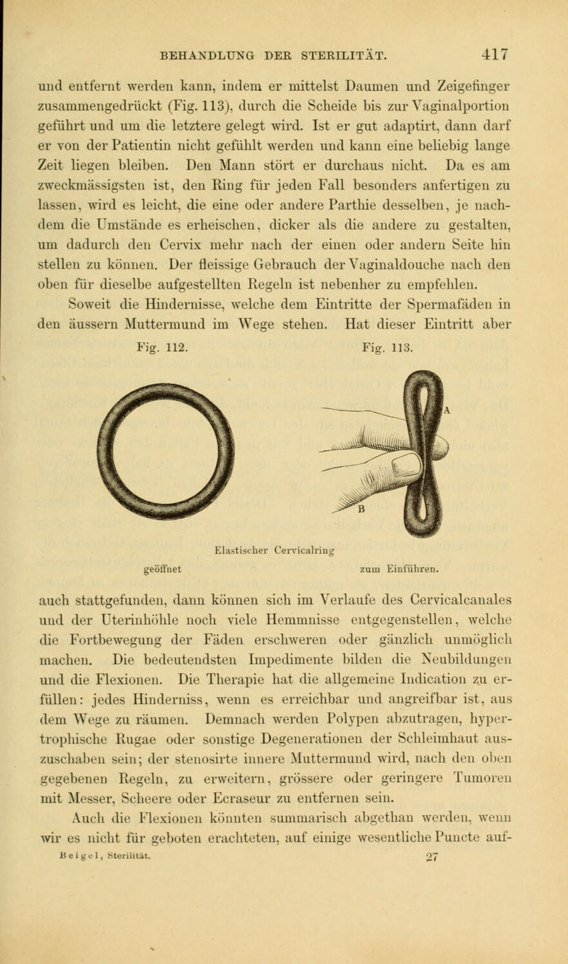 und entfernt werden kann, indem er mittelst Daumen und Zeigefinger zusammengedrückt (Fig. 113), durch die Scheide bis zur Vaginalportion geführt und um die letztere gelegt wird. Ist er gut adaptirt, dann darf er von der Patientin nicht gefühlt werden und kann eine beliebig lange Zeit liegen bleiben. Den Mann stört er durchaus nicht. Da es am zweckmässigsten ist, den Ring für jeden Fall besonders anfertigen zu lassen, wird es leicht, die eine oder andere Parthie desselben, je nach- dem die Umstände es erheischen, dicker als die andere zu gestalten, um dadurch den Cervix mehr nach der einen oder andern Seite hin stellen zu können. Der fleissige Gebrauch der Vaginaldouche nach den oben für dieselbe aufgestellten Regeln ist nebenher zu empfehlen. Soweit die Hindernisse, welche dem Eintritte der Spermafäden in den äussern Muttermund im Wege stehen. Hat dieser Eintritt aber Fig. 112. Fig. 113. Klastischer Cervicalring geöffnet zum Einführen. auch stattgefunden, dann können sich im Verlaufe des Cervicalcanales und der Uterinhöhle noch viele Hemmnisse entgegenstellen, welche die Fortbewegung der Fäden erschweren oder gänzlich unmöglich machen. Die bedeutendsten Impedimente bilden die Neubildungen und die Flexionen. Die Therapie hat die allgemeine Indication zu er- füllen: jedes Hinderniss, wenn es erreichbar und angreifbar ist, aus dem Wege zu räumen. Demnach werden Polypen abzutragen, hyper- trophische Rugae oder sonstige Degenerationen der Schleimhaut aus- zuschaben sein; der stenosirte innere Muttermund wird, nach den oben gegebenen Regeln, zu erweitern, grössere oder geringere Tumoren mit Messer, Scheere oder Ecraseur zu entfernen sein. Aueli die Flexionen könnten summarisch abgethan werden, wenn wir es nicht für geboten erachteten, auf einige wesentliche Puncte auf- Beigel, Sterilität. 27