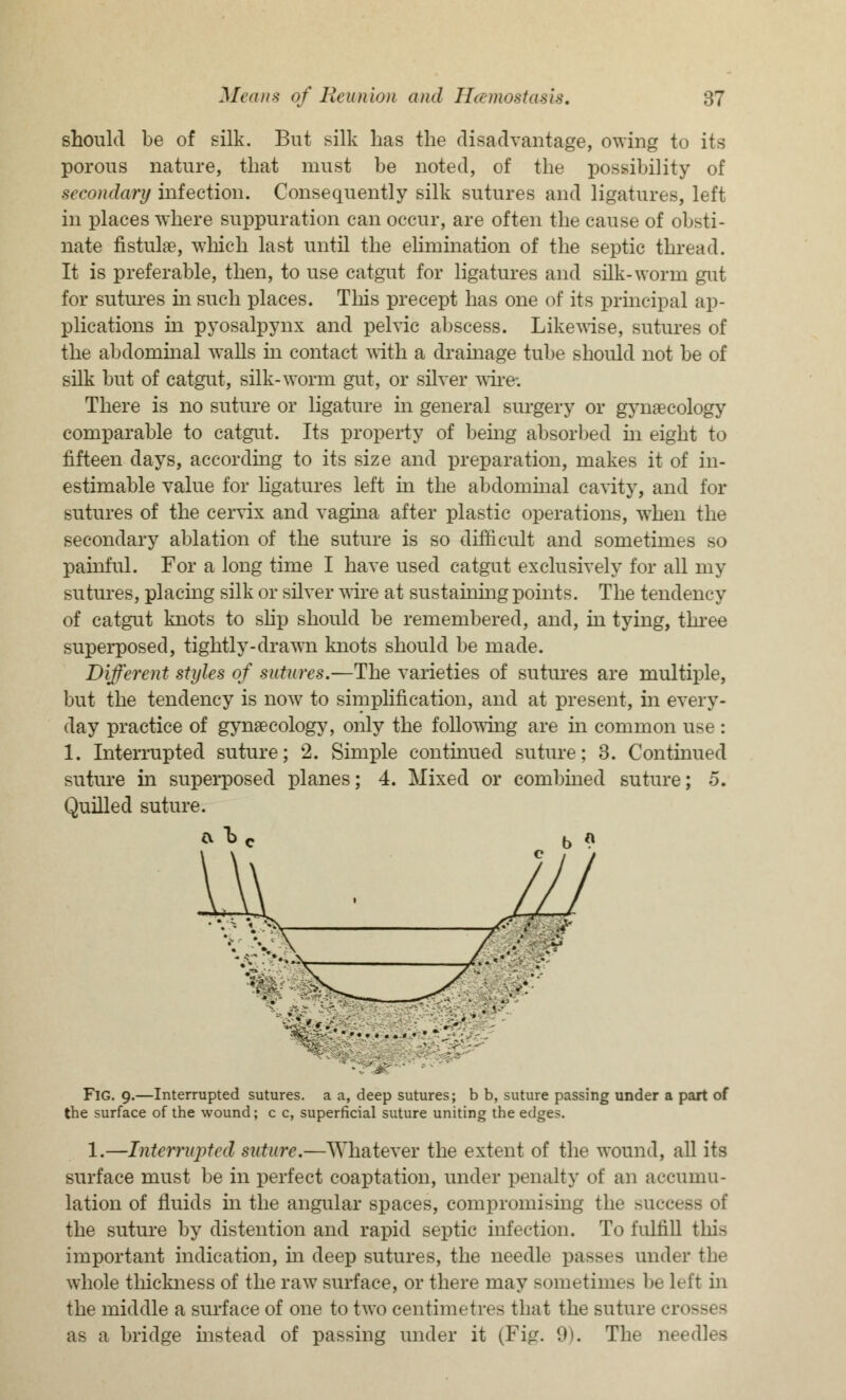 should be of silk. But silk lias the disadvantage, owing to its porous nature, that must be noted, of the possibility of secondary infection. Consequently silk sutures and ligatures, left in places where suppuration can occur, are often the cause of obsti- nate fistula?, which last until the elimination of the septic thread. It is preferable, then, to use catgut for ligatures and silk-worm gut for sutures hi such places. This precept has one of its principal ap- plications hi pyosalpynx and pelvic abscess. Likewise, sutures of the abdominal walls in contact with a drainage tube should not be of silk but of catgut, silk-worm gut, or silver wire. There is no suture or ligature in general surgery or gynaecology comparable to catgut. Its property of being absorbed hi eight to fifteen days, according to its size and preparation, makes it of in- estimable value for ligatures left in the abdominal cavity, and for sutures of the cervix and vagina after plastic operations, when the secondary ablation of the suture is so difficult and sometimes so painful. For a long time I have used catgut exclusively for all my sutures, placing silk or silver wire at sustaining points. The tendency of catgut knots to slip should be remembered, and, in tying, three superposed, tightly-drawn knots should be made. Different styles of sutures.—The varieties of sutures are multiple, but the tendency is now to simplification, and at present, in every- day practice of gynaecology, only the following are in common use: 1. Interrupted suture; 2. Simple continued suture; 3. Continued suture in superposed planes; 4. Mixed or combined suture; 5. Quilled suture. FlG. 9.—Interrupted sutures, a a, deep sutures; b b, suture passing under a part of the surface of the wound; c c, superficial suture uniting the edges. 1.—Interrupted suture.—Whatever the extent of the wound, all its surface must be in perfect coaptation, under penalty of an accumu- lation of fluids in the angular spaces, compromising the success of the suture by distention and rapid septic infection. To fulfill this important indication, in deep sutures, the needle passes under the whole thickness of the raw surface, or there may sometimes be left in the middle a surface of one to two centimetres that the suture crosses as a bridge instead of passing under it (Fig. 9). The needles