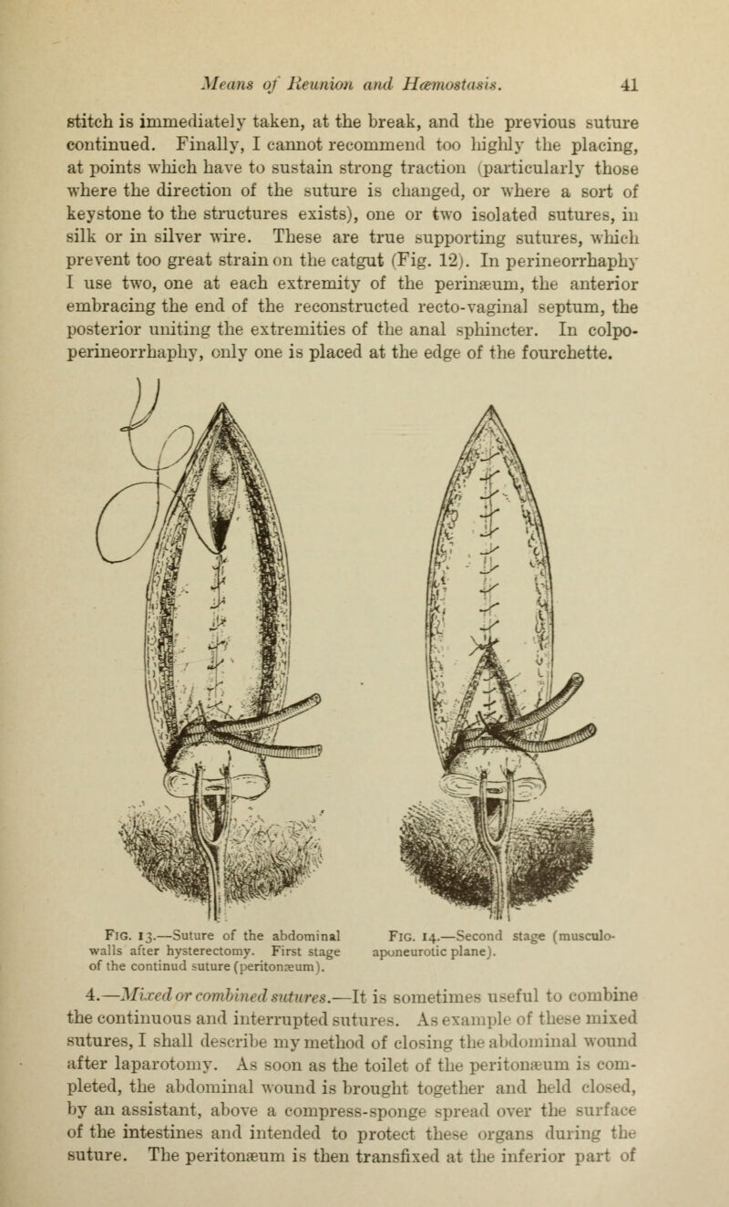 stitch is immediately taken, at the break, and the previous suture continued. Finally, I cannot recommend too highly the placing, at points which have to sustain strong traction (particularly those where the direction of the suture is changed, or where a sort of keystone to the structures exists), one or two isolated sutures, in silk or in silver wire. These are true supporting sutures, winch prevent too great strain on the catgut (Fig. 12). In perineorrhaphy I use two, one at each extremity of the perineum, the anterior embracing the end of the reconstructed recto-vaginal septum, the posterior uniting the extremities of the anal sphincter. In colpo- perineorrhaphy, only one is placed at the edge of the fourchette. Fig. 13.—Suture of the abdominal walls after hysterectomy. First stage of the continue! suture (peritonaeum). Fig. 14.—Second stage (musculo- aponeurotic plane). 4.—Mixed or combined sutures.—It is Bometimea useful to combine the continuous and interrupted sutures. A- example of these mixed sutures, I shall describe my method of closing the abdominal wound after laparotomy. As soon as the toilet of the peritoneum is com- pleted, the abdominal wound is brought together and held cl< by an assistant, above a compress-sponge spread over the surface of the intestines and intended to protect the>e organs during the suture. The peritonaeum is then transfixed at the inferior part of