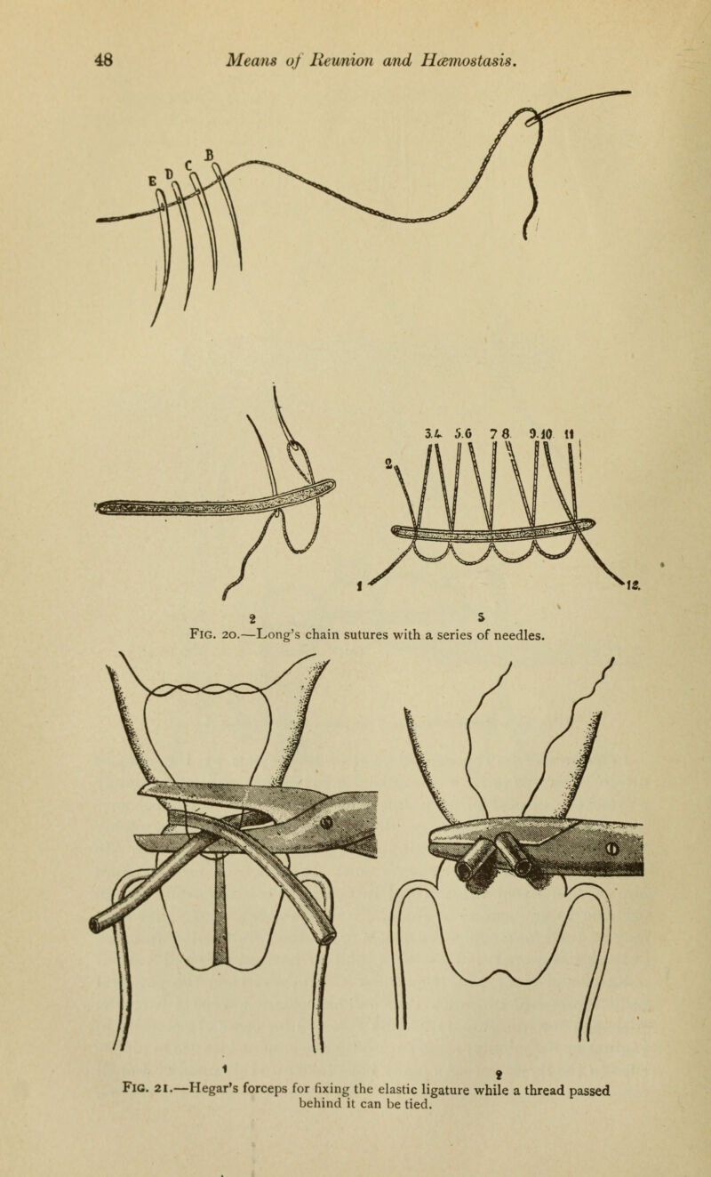 2 * Fig. 20.—Long's chain sutures with a series of needles. Fig. 21.—Hegar's forceps for fixing the elastic ligature while a thread passed behind it can be tied.