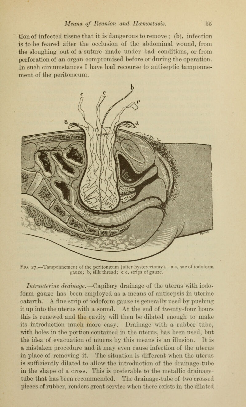 tionof infected tissue that it is dangerous to remove ; (b). infection is to be feared after the occlusion of the abdominal wound, from the sloughing out of a suture made under bad conditions, or from perforation of an organ compromised before or during the operation. In such circumstances I have had recourse to antiseptic tamponne- ment of the peritonaeum. Fig. 27.—Tamponnement of the peritonaeum (after hysterectomy), a a, sac of iodoform gauze; b, silk thread; c c, strips of gauze. Intrauterine drainage.—Capilary drainage of the uterus with iodo- form gauze has been employed as a means of antisepsis in uterine catarrh. A fine strip of iodoform gauze is generally used by pushing it up into the uterus with a sound. At the end of twenty-four hours this is renewed and the cavity will then be dilated enough to make its introduction much more easy. Drainage with a rubber tube, with holes in the portion contained in the uterus, has been used, but the idea of evacuation of mucus by this means is an illusion. It is a mistaken procedure and it may even cause infection of the uterus in place of removing it. The situation is different when the uterus is sufficiently dilated to allow the introduction of the drainage-tube in the shape of a cross. This is preferable to the metallic drainage- tube that has been recommended. The drainage-tube of two en pieces of rubber, renders great service when there exists in the dilated